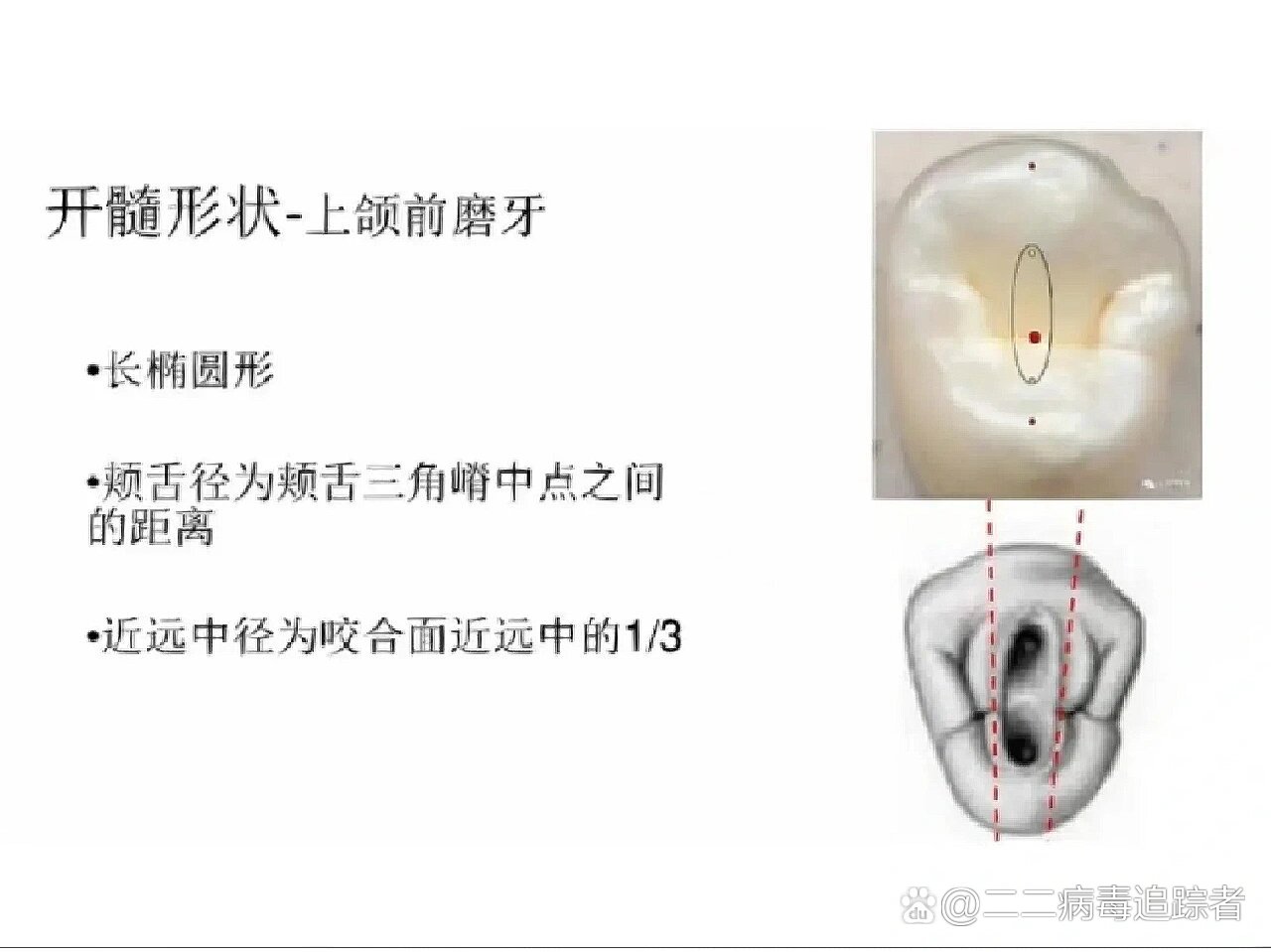 牙体牙髓～开髓形状图示