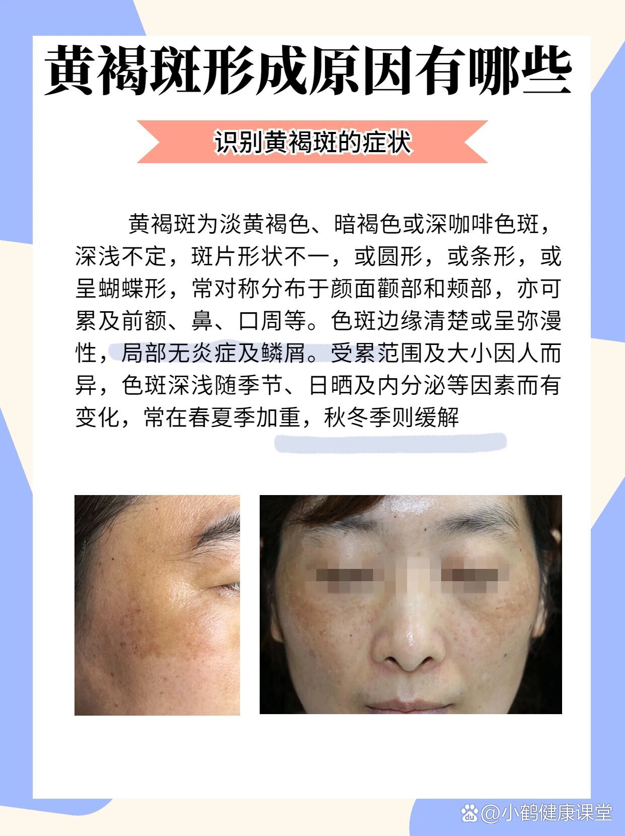 黄褐斑的形成原因有哪些?