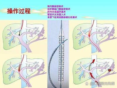 内镜下套扎硬化与tips治疗肝硬化消化道出血有啥不同?