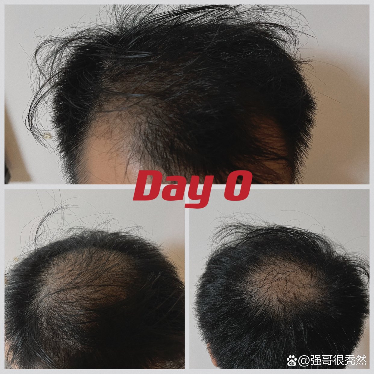 植发是我最后悔的事植发前后第246天#发际线种植#