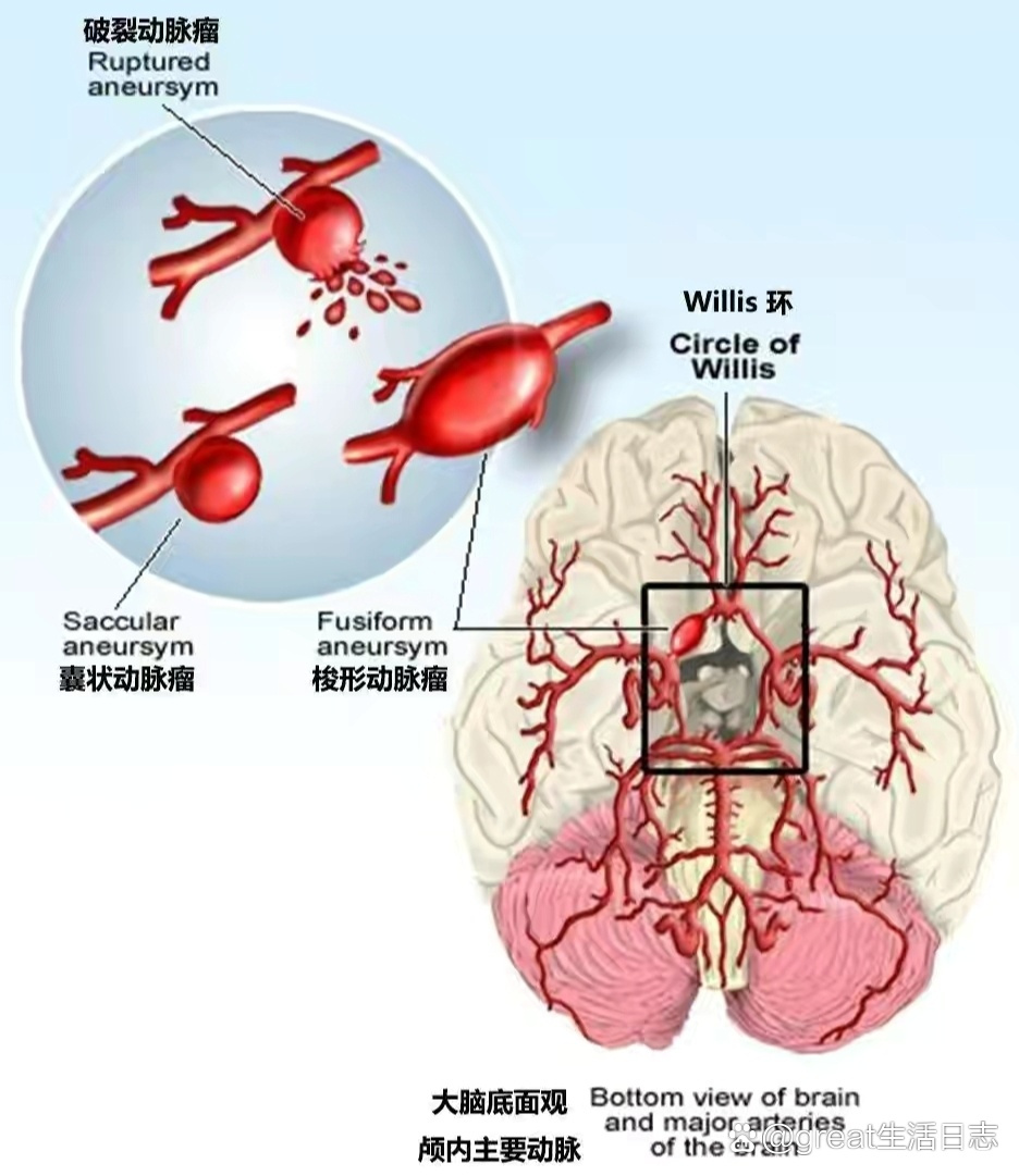 颅内动脉瘤有几种治疗方式呢?