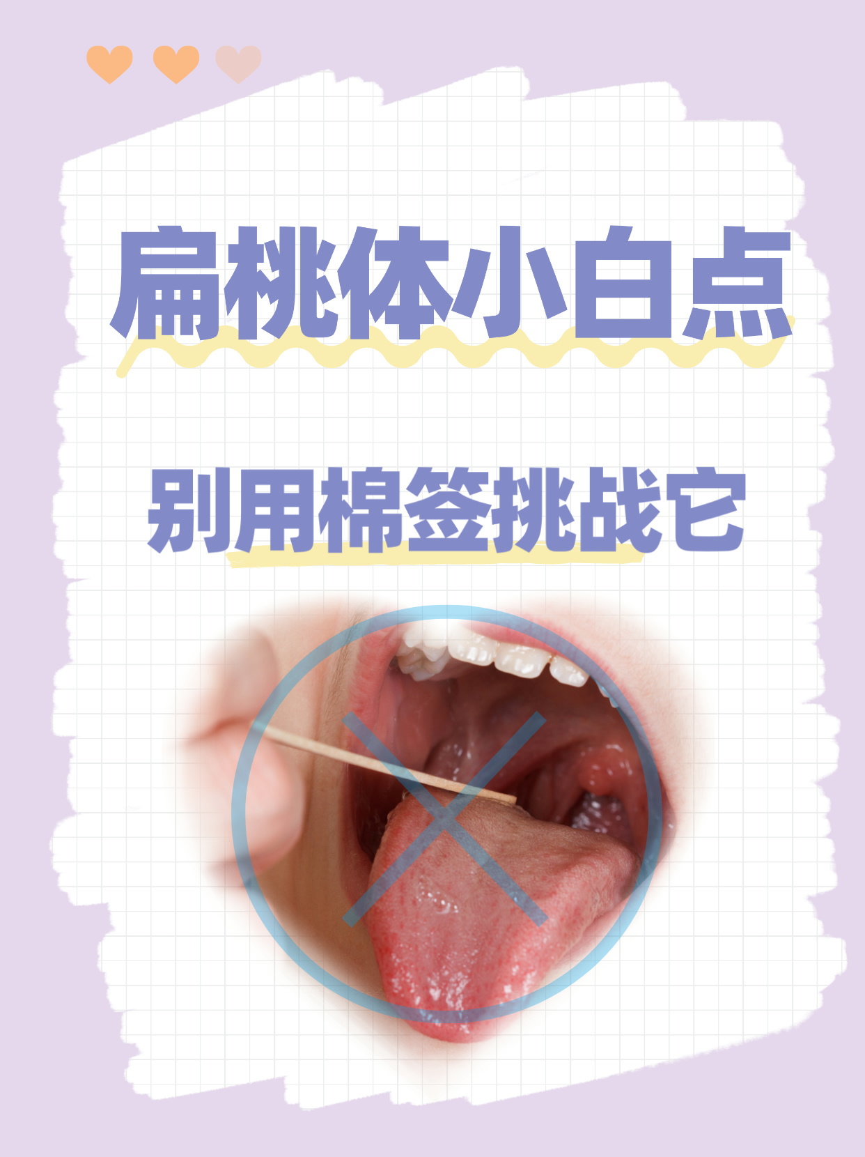 扁桃体隐窝清理棉签图片