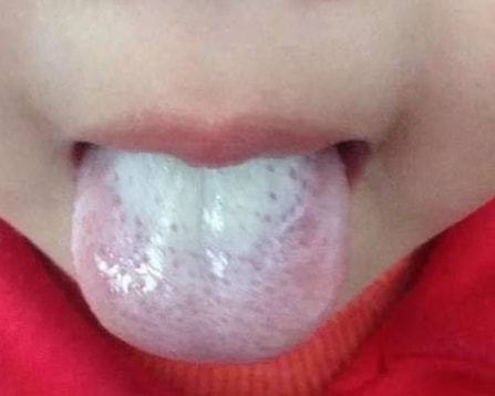 一眼分辨,孩子是脾阳虚,脾气虚还是脾阴虚,带娃的妈妈一看就会!