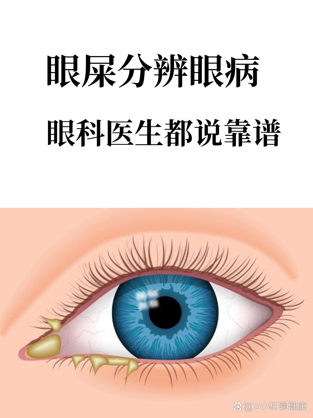 眼屎分辨眼病?