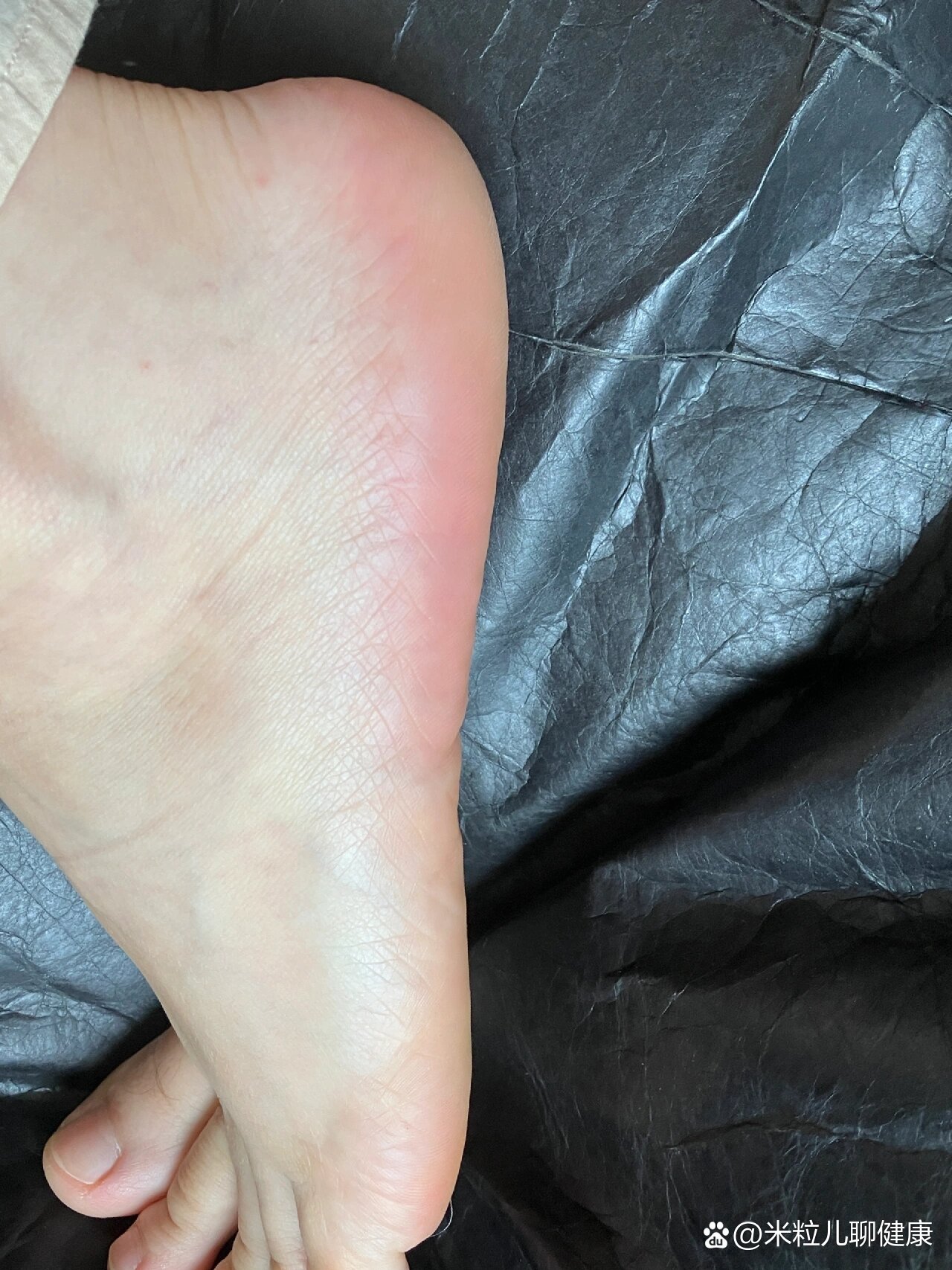脚后跟粗糙龟裂得救了