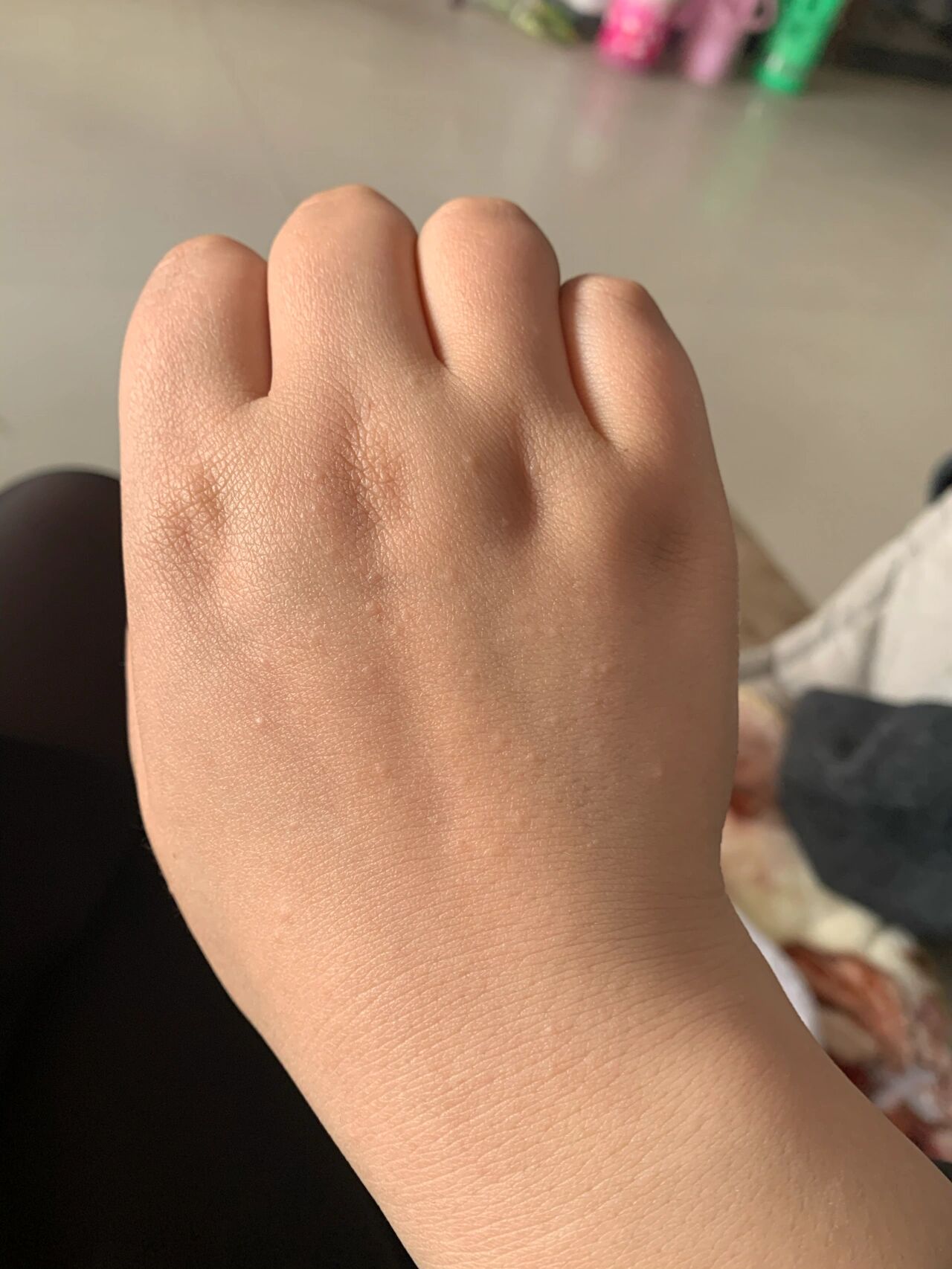 手背上起了好多疙瘩这是什么东西
