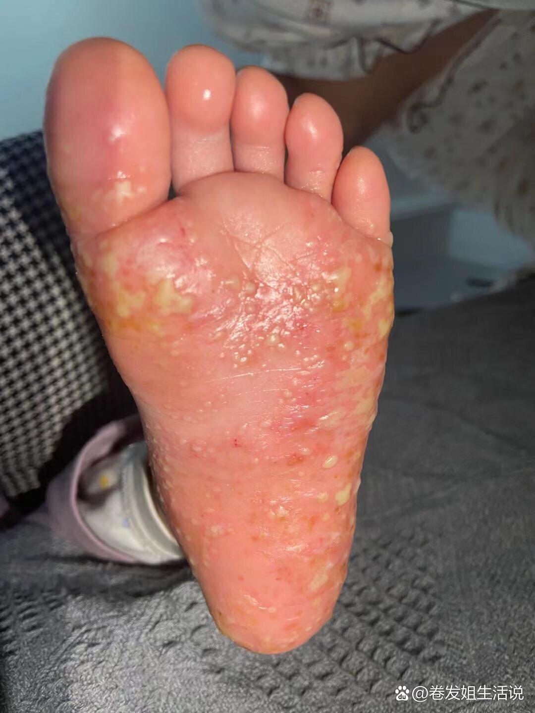 2月7个月的掌跖脓包病患者