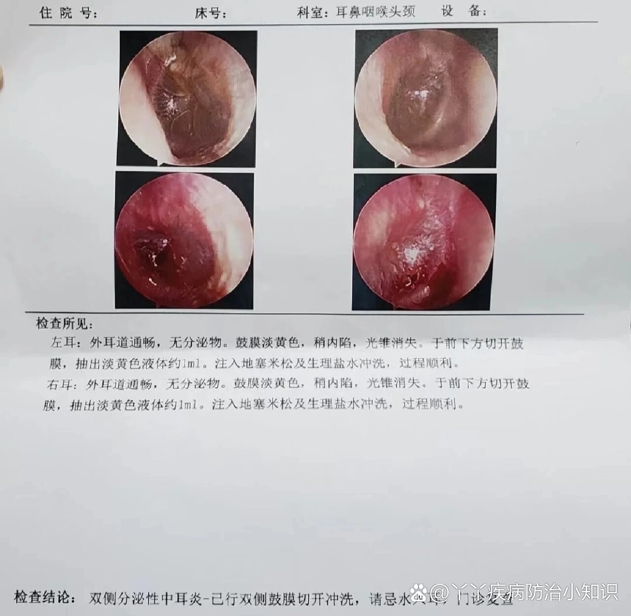 电耳镜正常人鼓膜图片图片