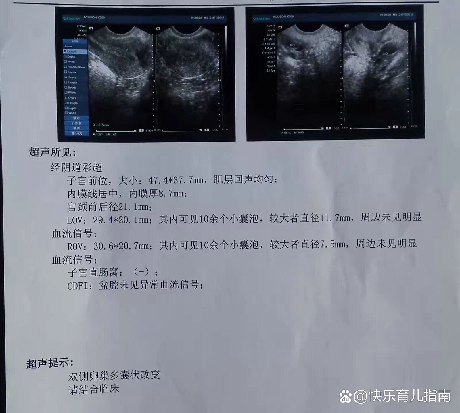 单侧卵巢多囊能自然怀孕吗(单侧卵巢多囊可以正常排卵影响生育么)