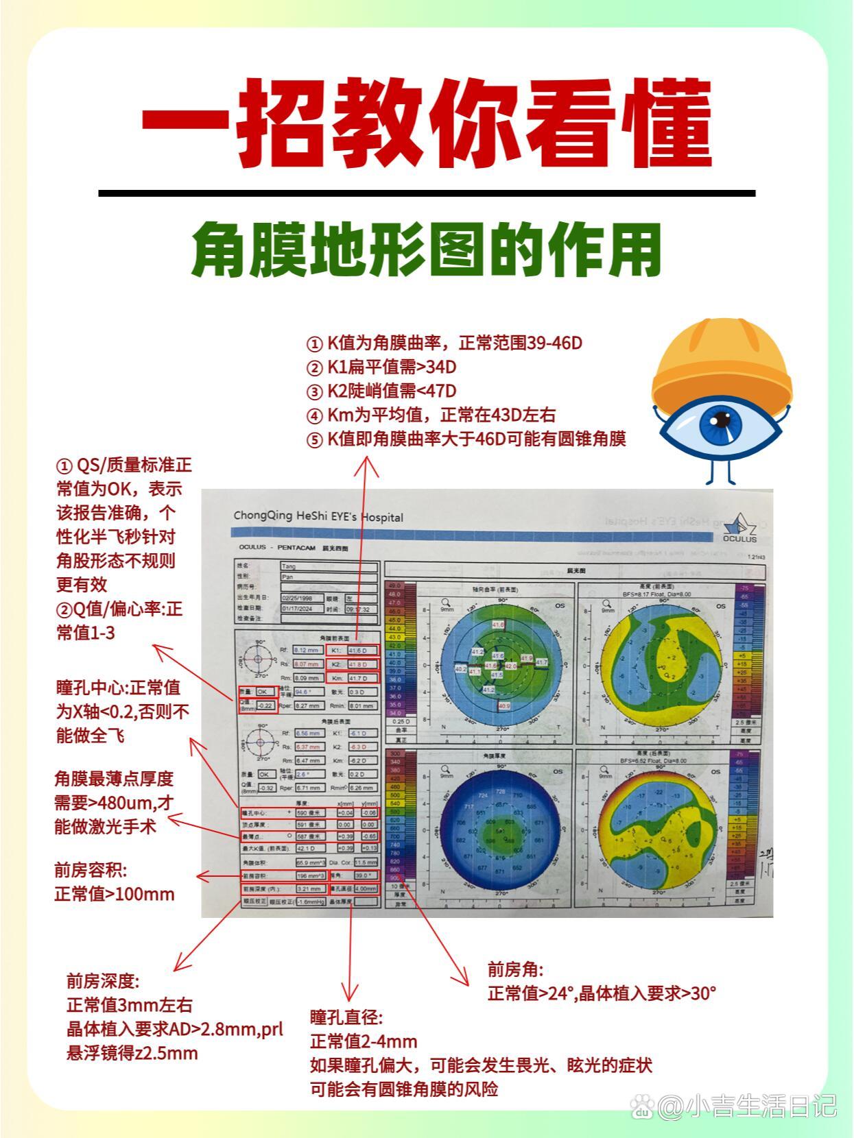 角膜地形图上看kappa角图片