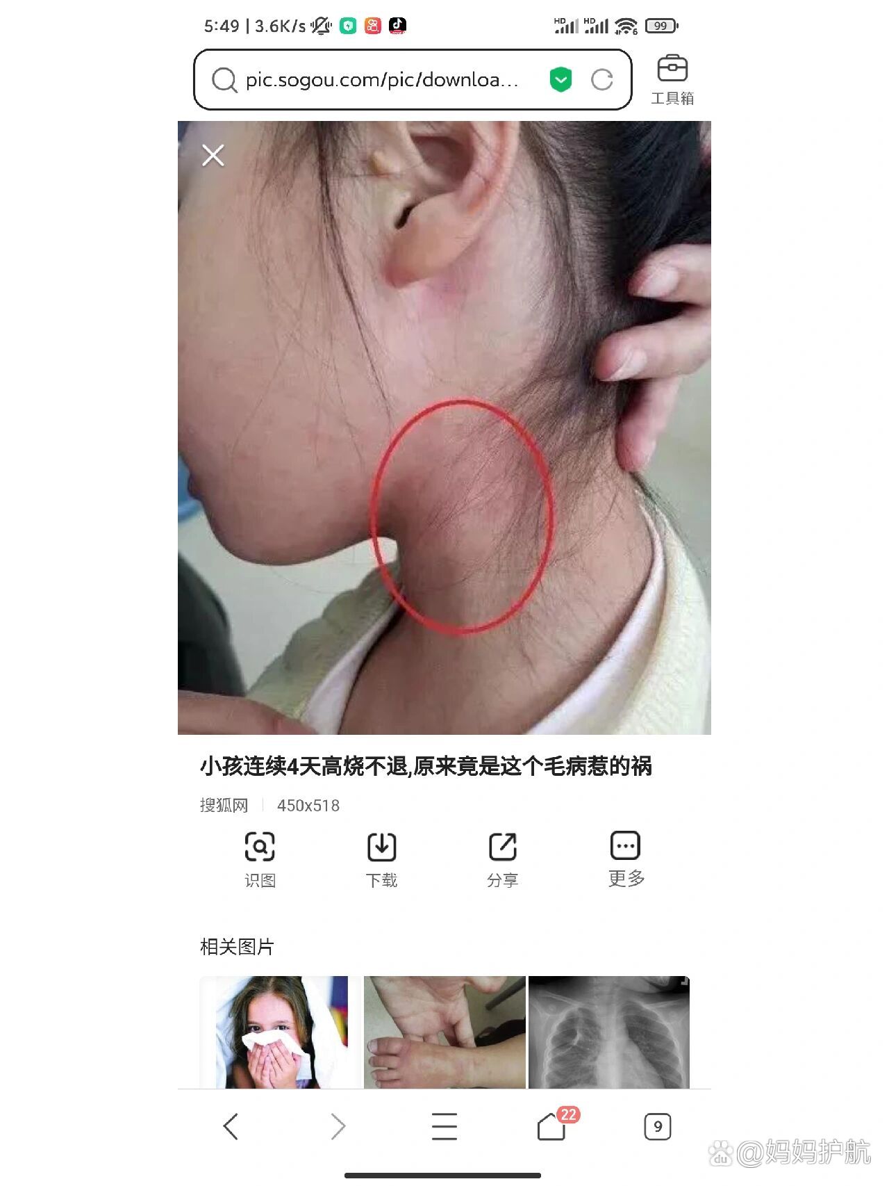 脖子正常淋巴结图片图片