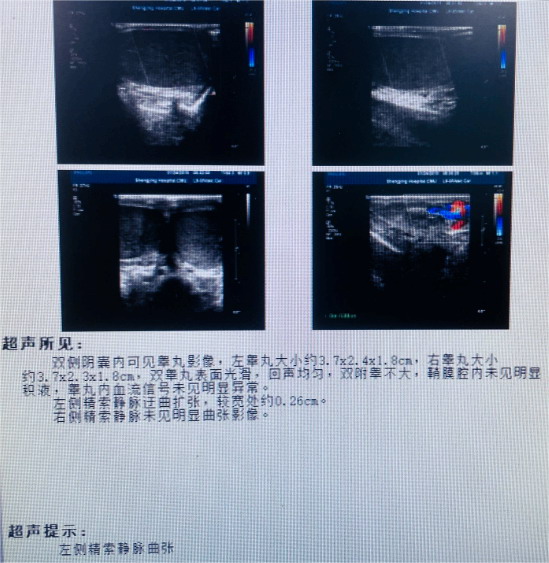 22岁年轻患者的精索静脉曲张诊治经过