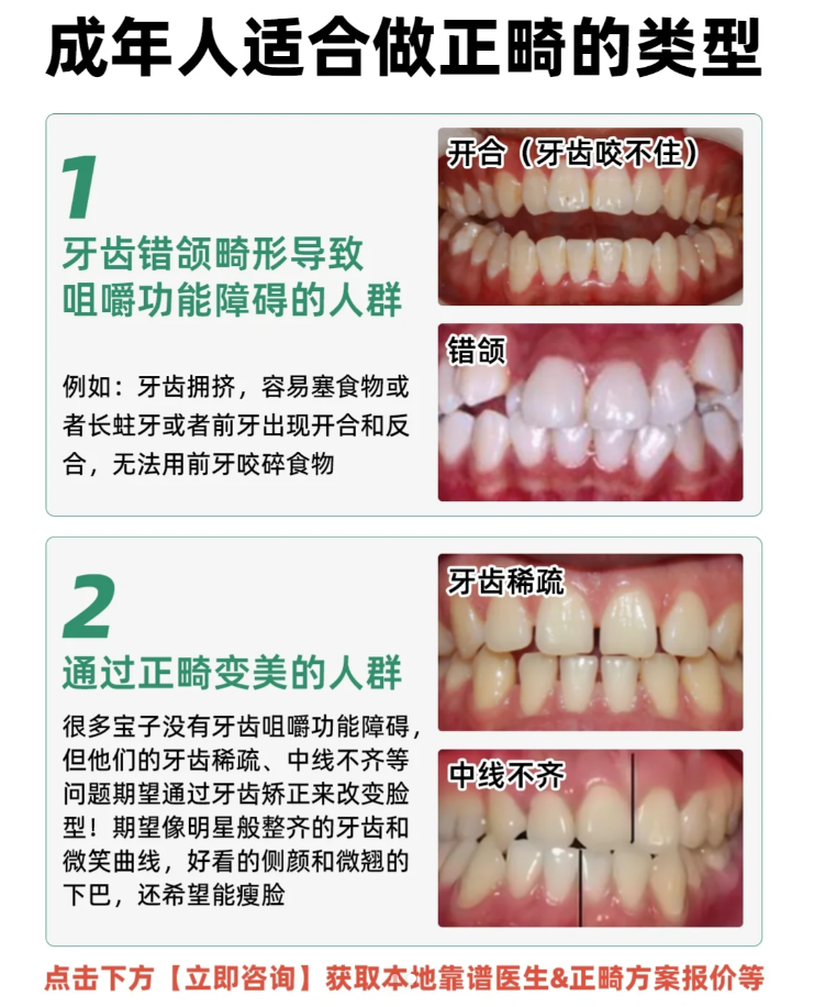 适合成年人矫正的类型&矫正器类型功课