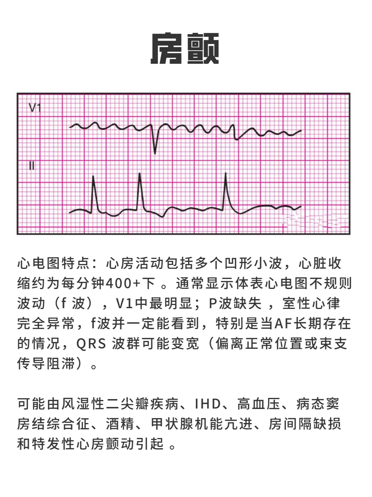 室颤与室扑心电图特点图片