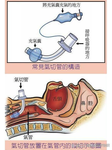 气管插管图片位置图