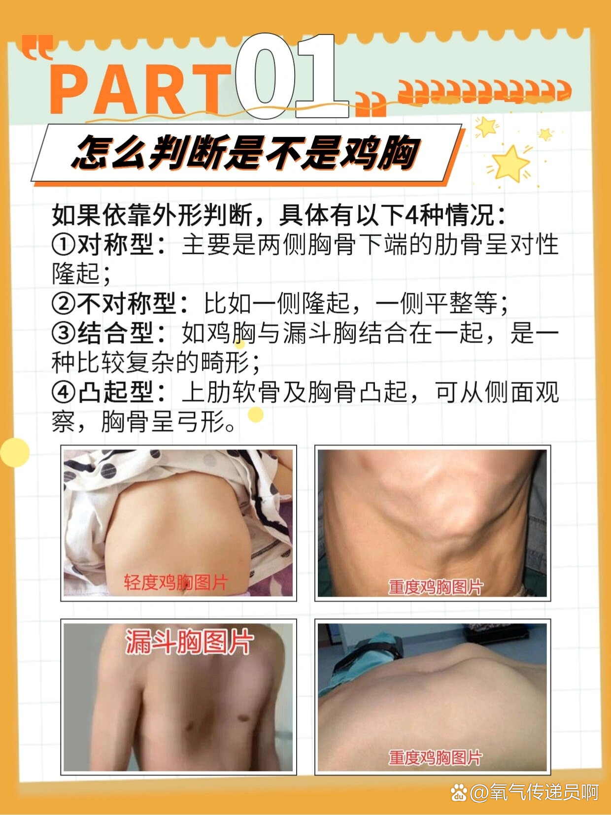 孩子鸡胸怎么办?