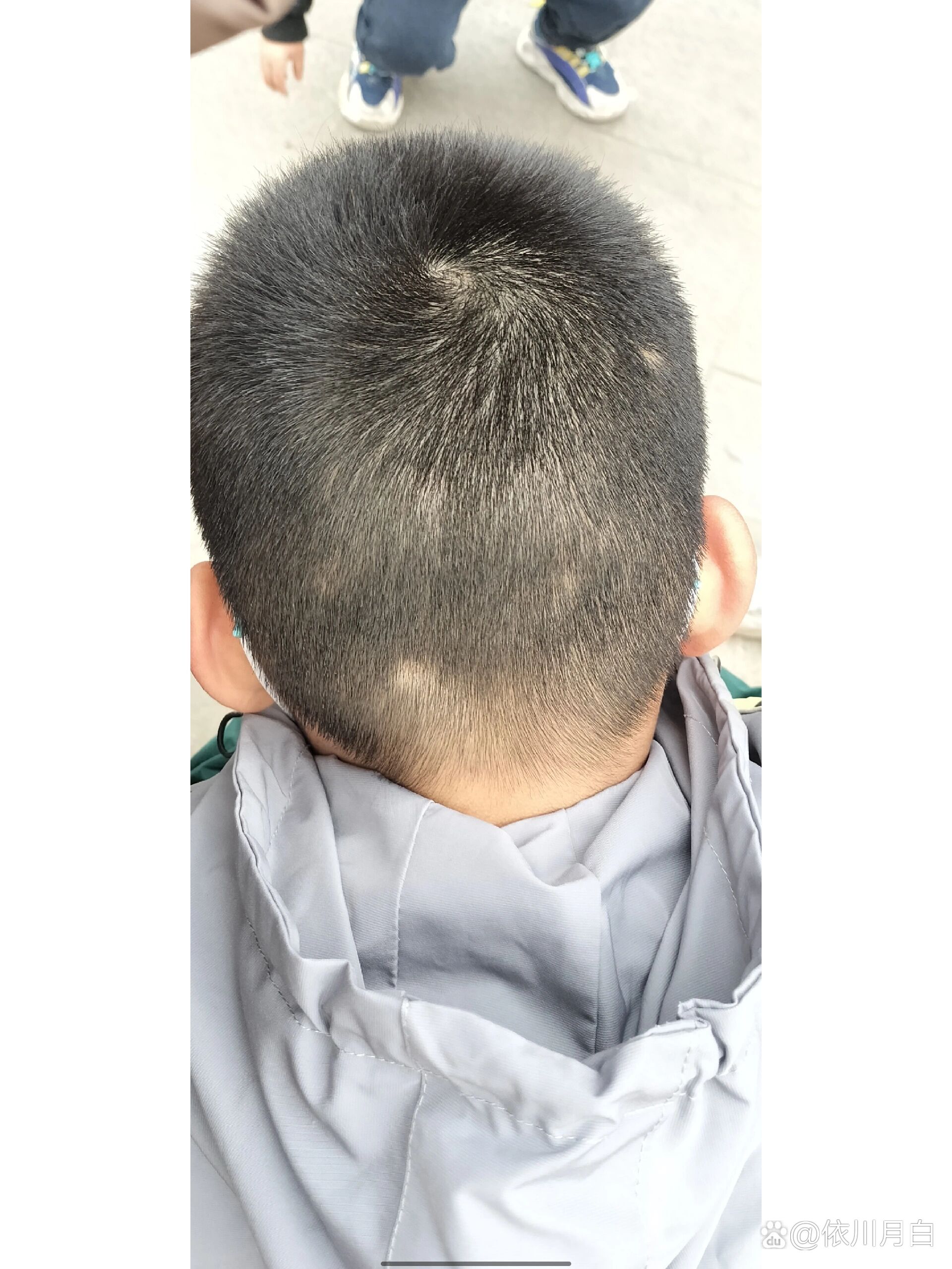 10周岁的男孩头发突然出现少头发
