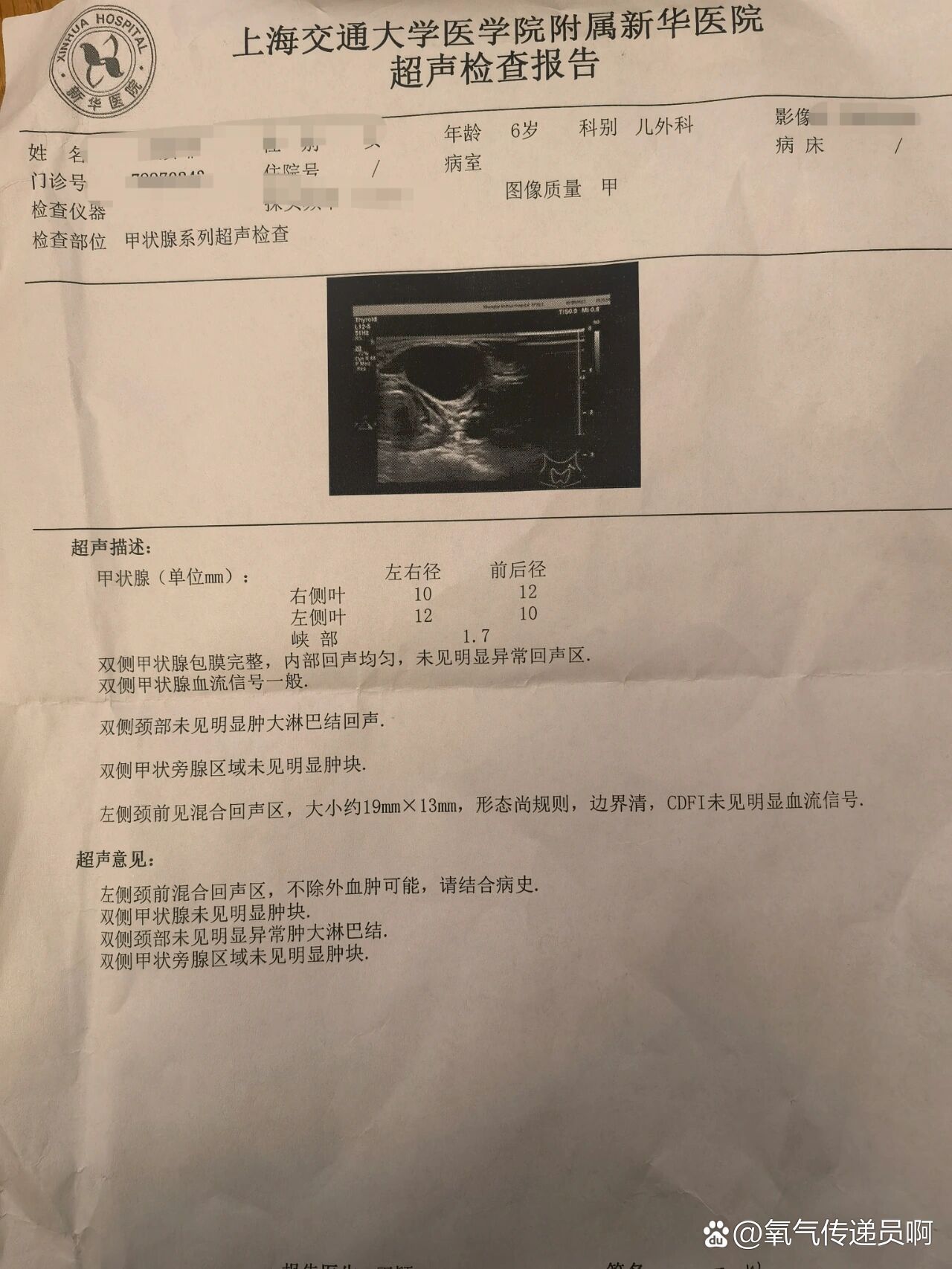 做了两次彩超,医生说是甲状舌管囊肿,要手术切除好怕,心里没底!
