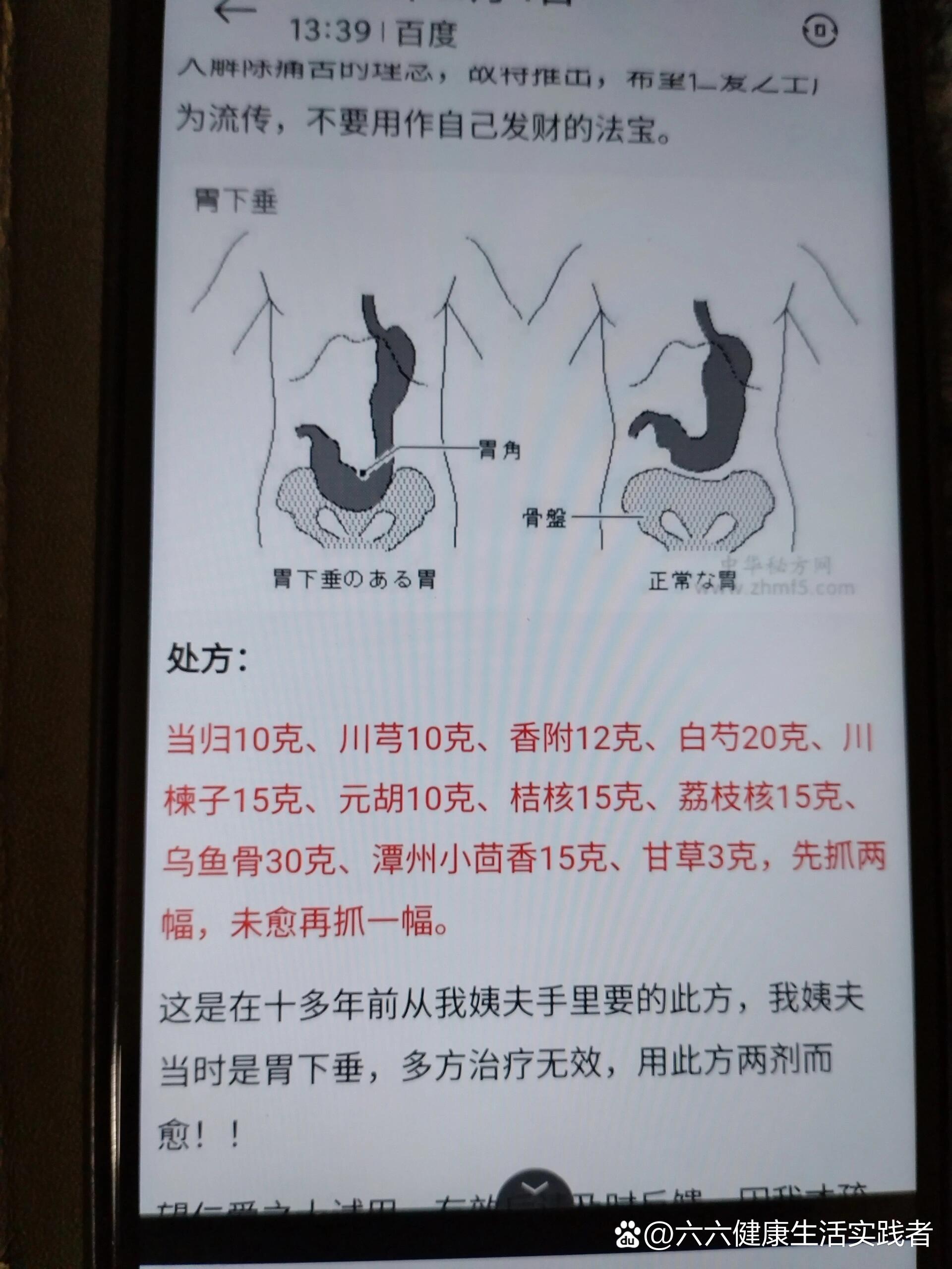 患胃下垂后的那些事