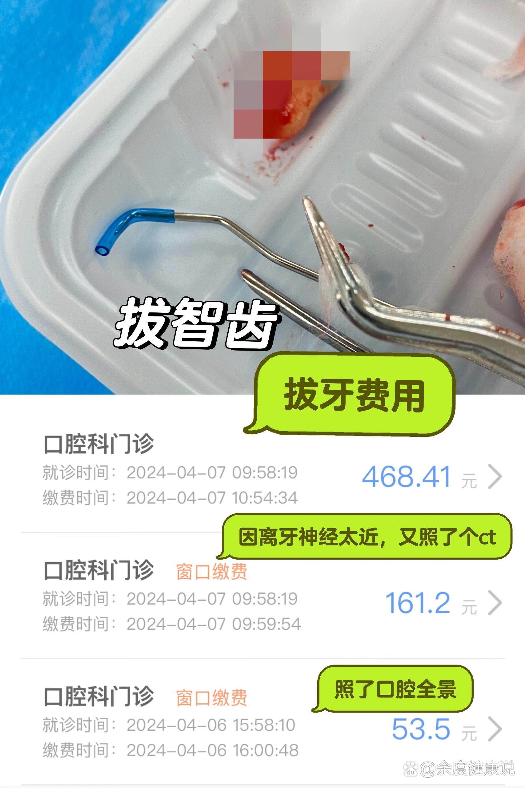 大家拔的智齿花了多少钱?