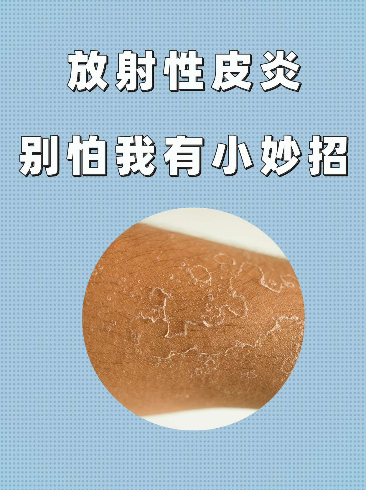 放射性皮炎?别怕,我有小妙招