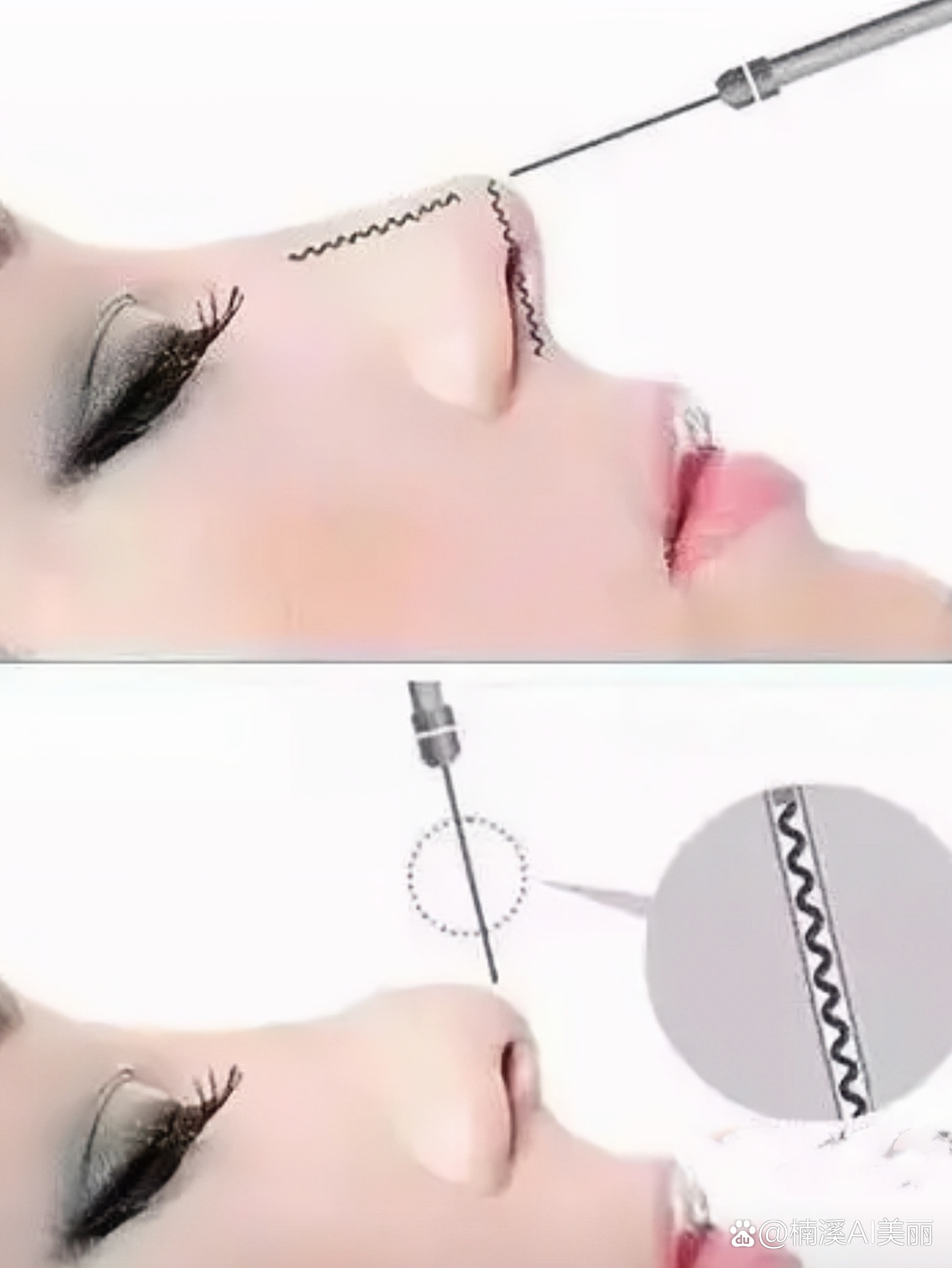 确认自身身体状况:在进行面部线雕或线雕隆鼻前,应确认自身身体状况