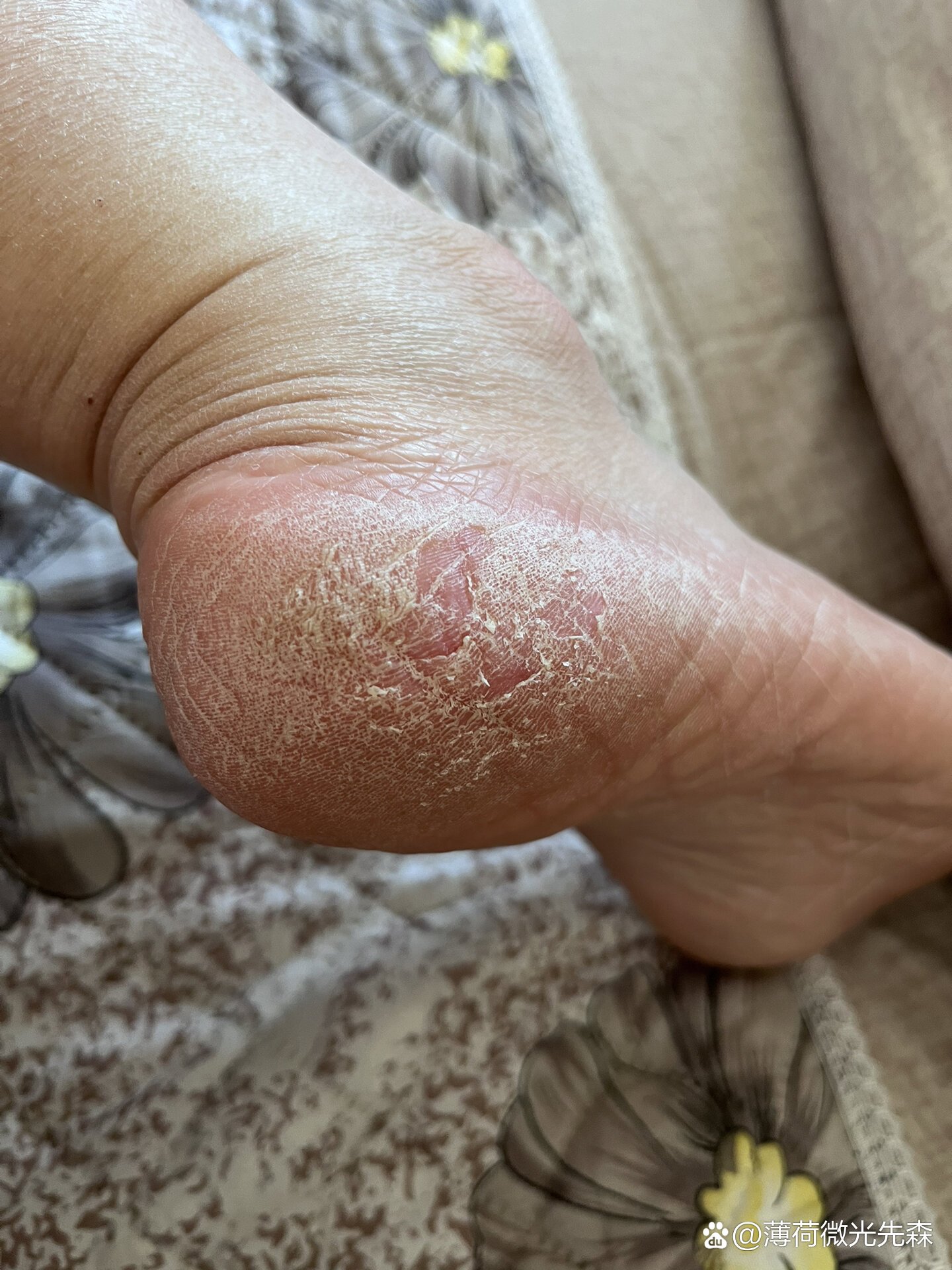 脚后跟干裂怎么办