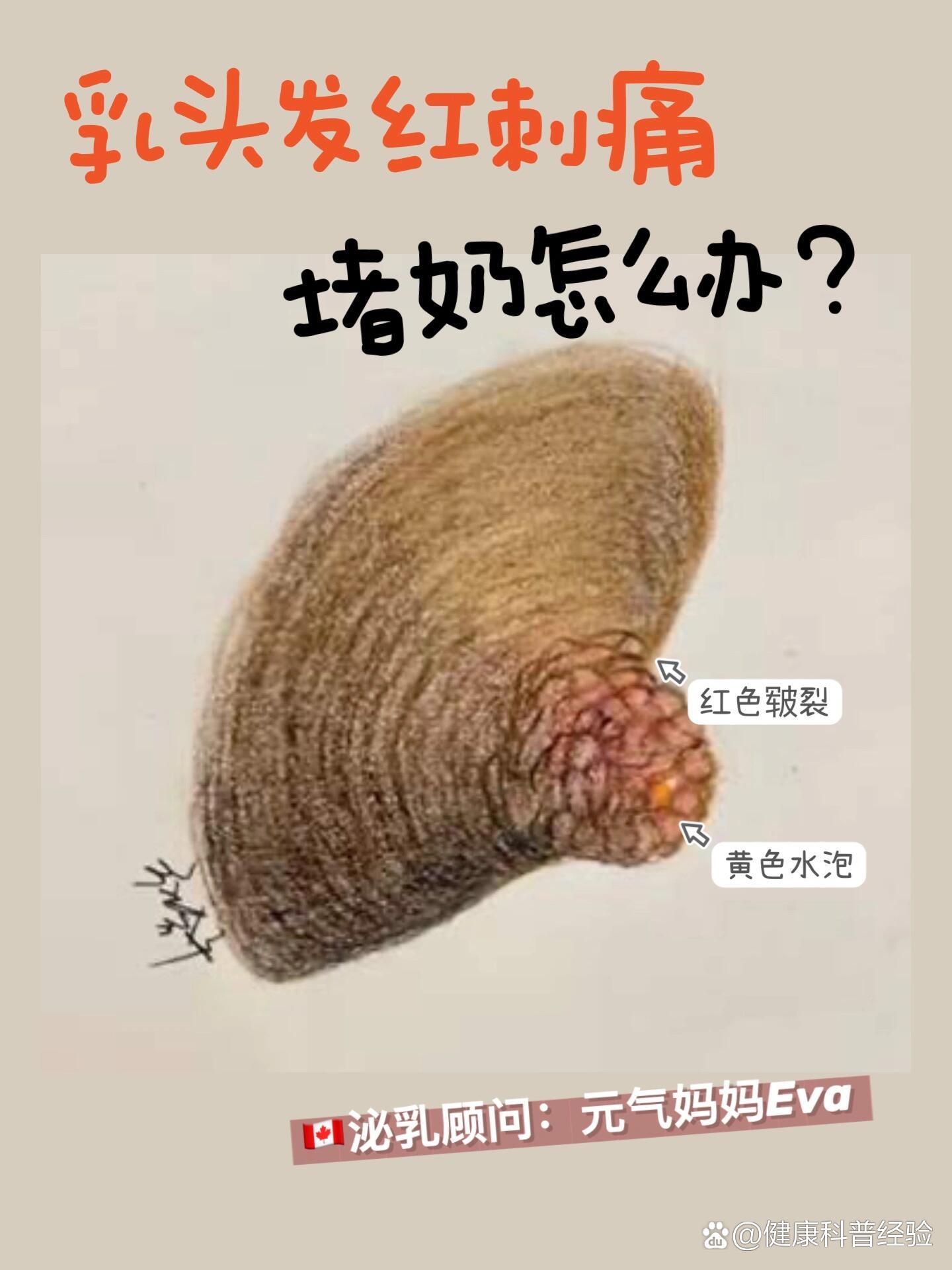 皲裂红肿水泡……这种堵奶怎么办?