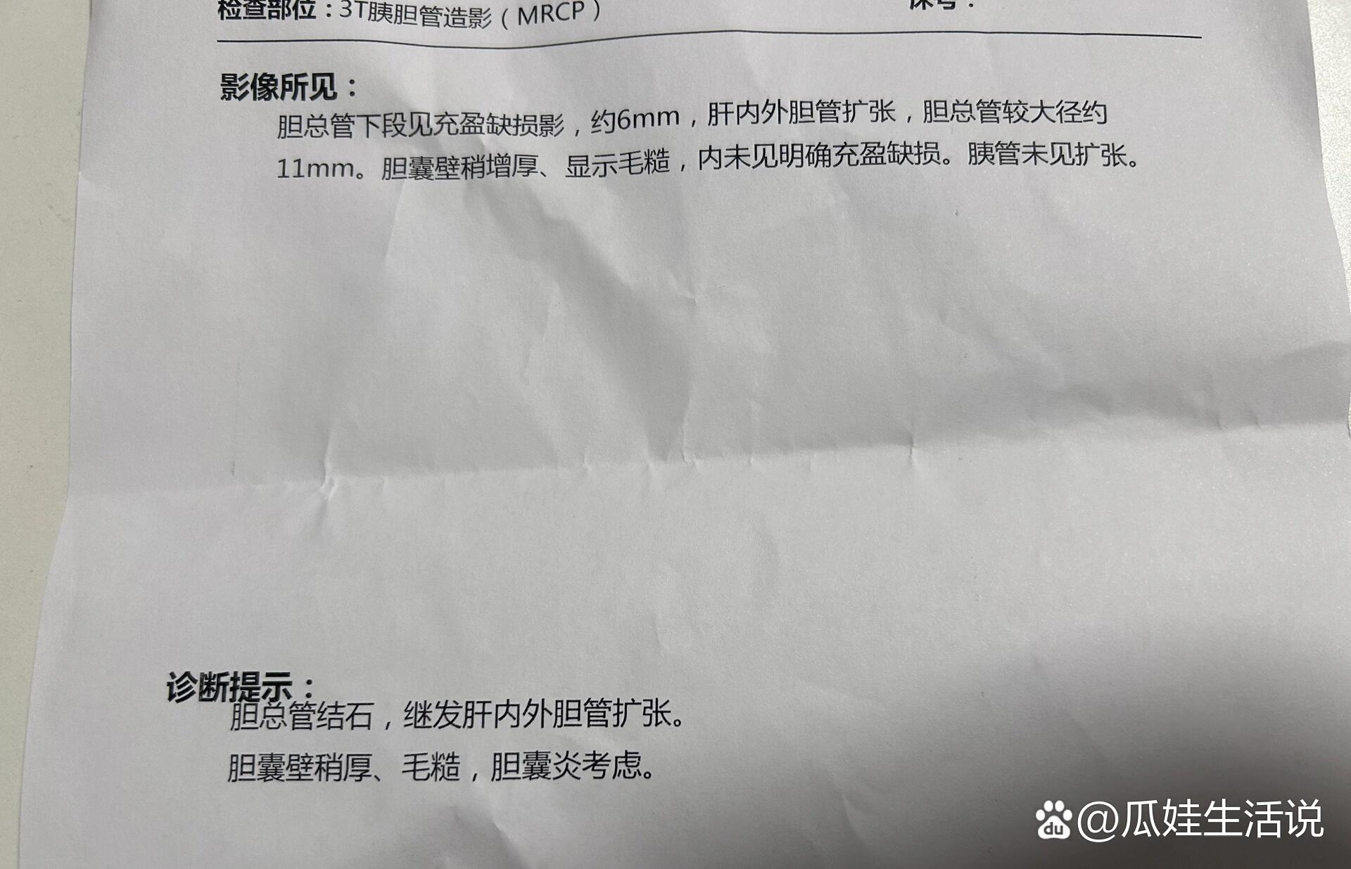 胆总管结石一定要做手术吗