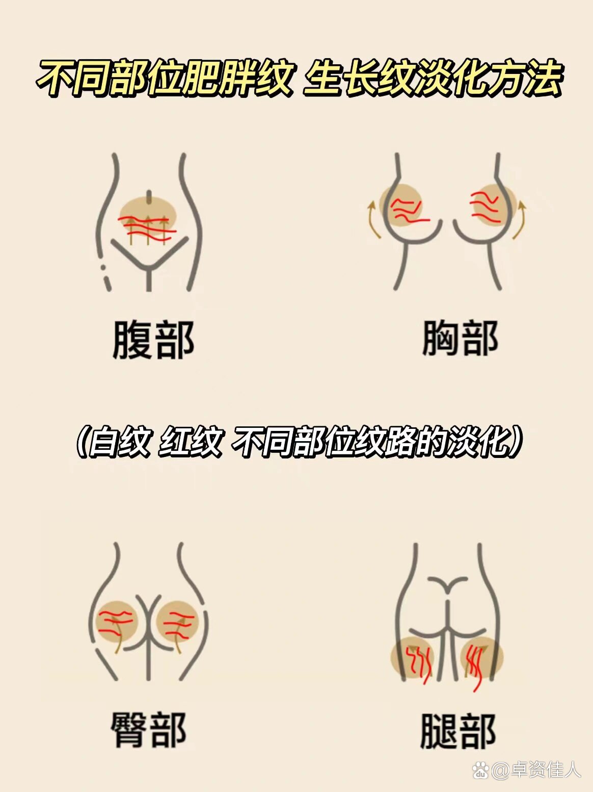 乳房肥胖纹图片