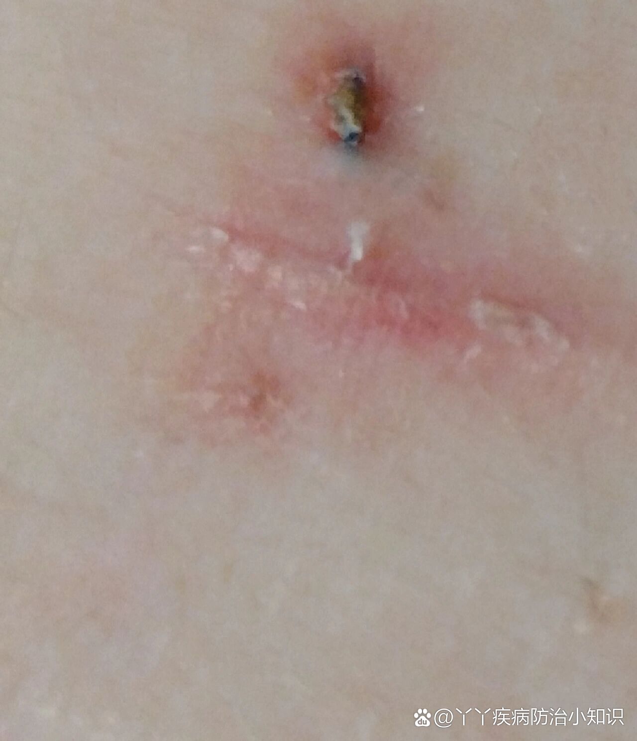 阑尾手术40天,伤口处有条线完全未被吸收