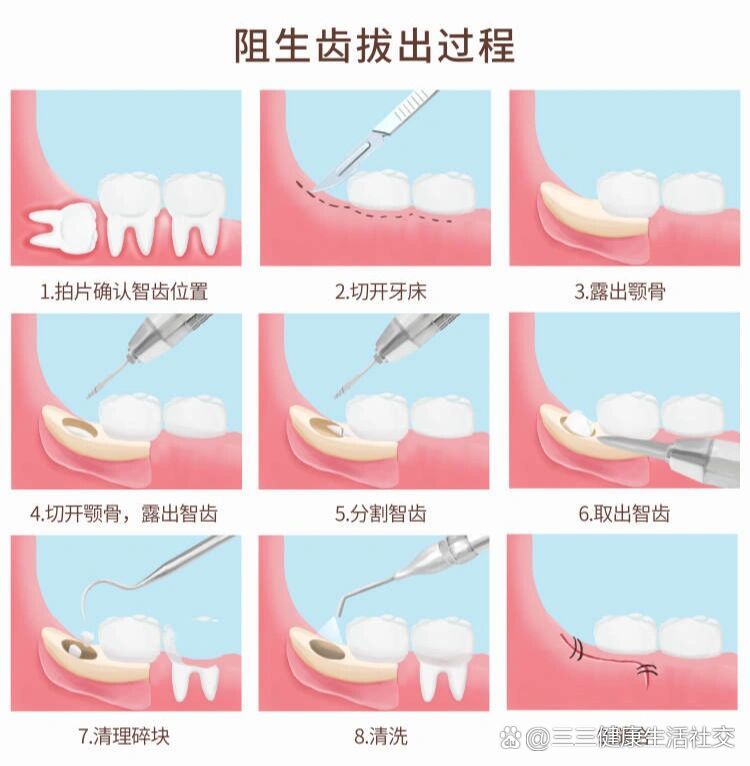  p>长了智齿,到底要不要拔呢? br>"牙疼不是病,疼起来要人命".