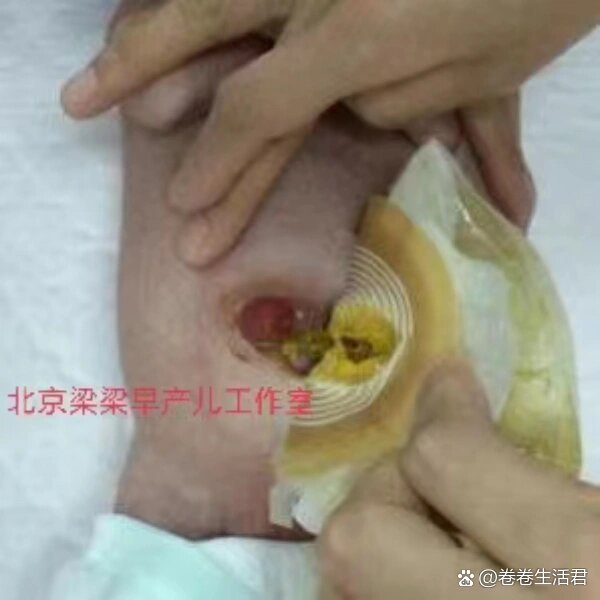 早产儿小肠坏死性结肠炎,在医学上叫做坏死性小肠结肠炎,它主要是以