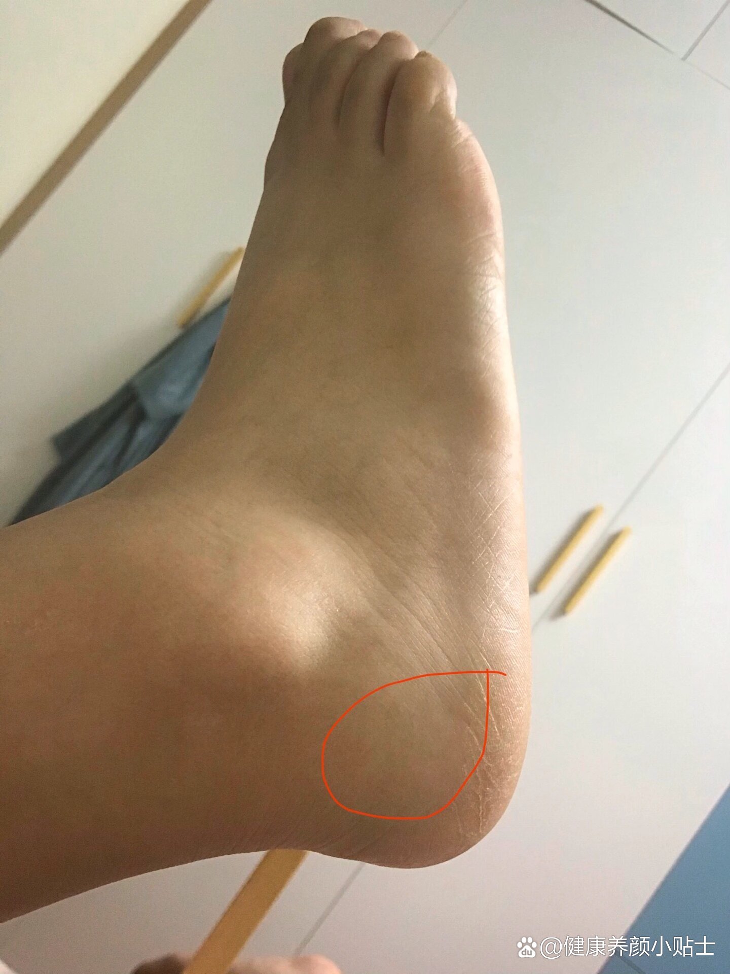 足底外侧筋膜炎