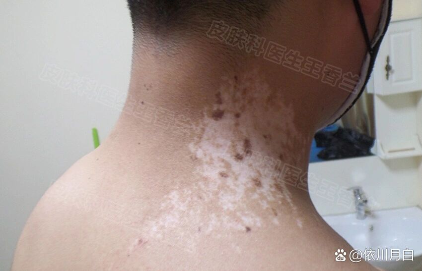 其实除了白癜风外,白色糠疹,花斑癣,贫血痣等在发病时也会使皮肤长