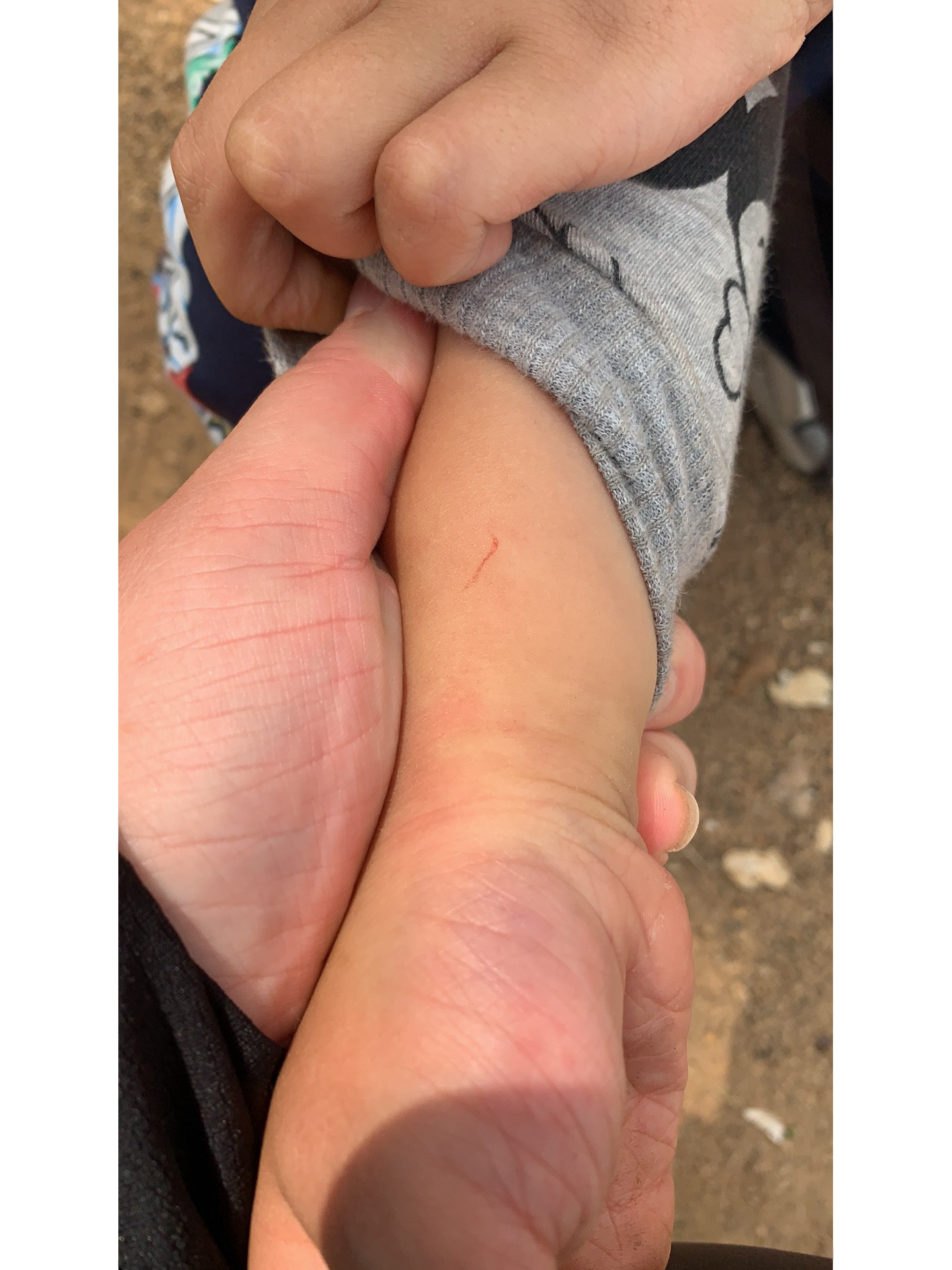 求助,被猴子挠了一把,需要打疫苗吗