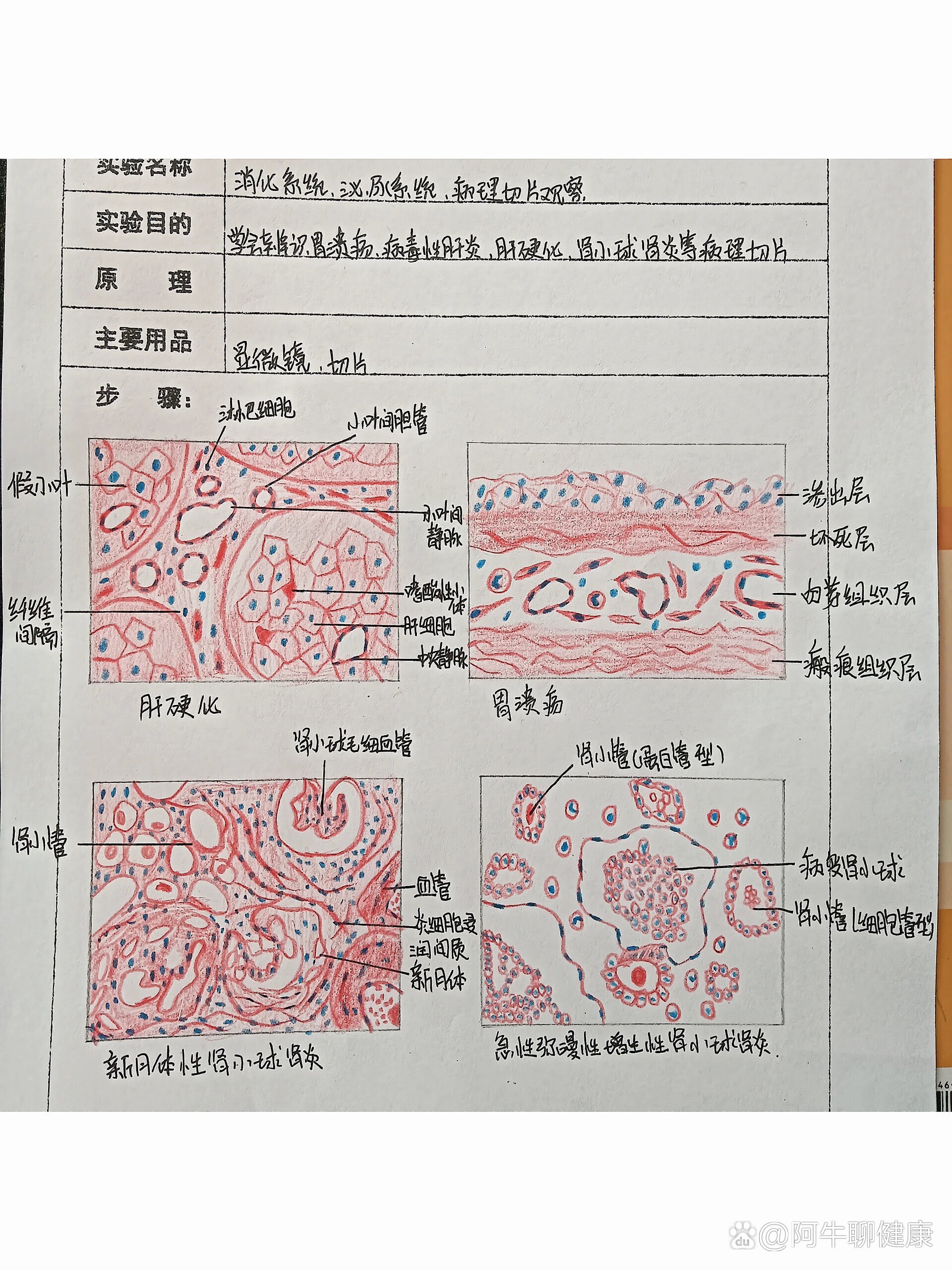 泌尿系统,病理切片观察 br>肝硬化  br>胃溃疡  br>新月体肾炎  br>