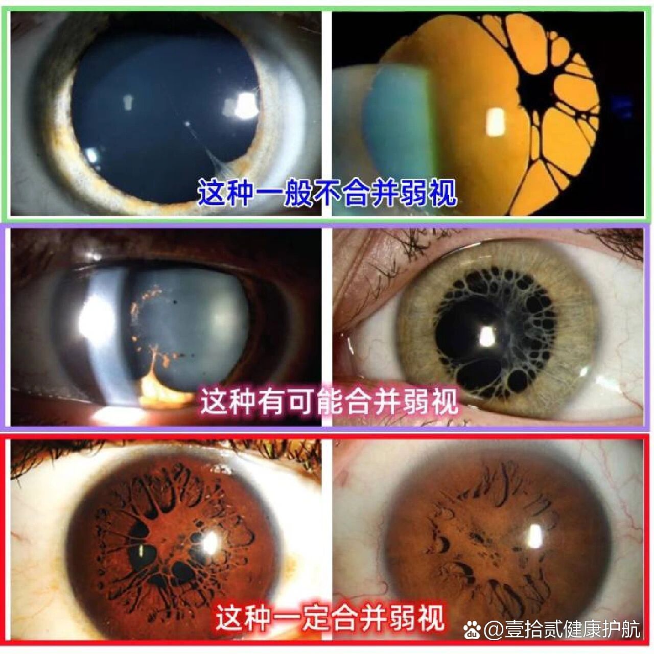 瞳孔残膜,到底要不要做手术?