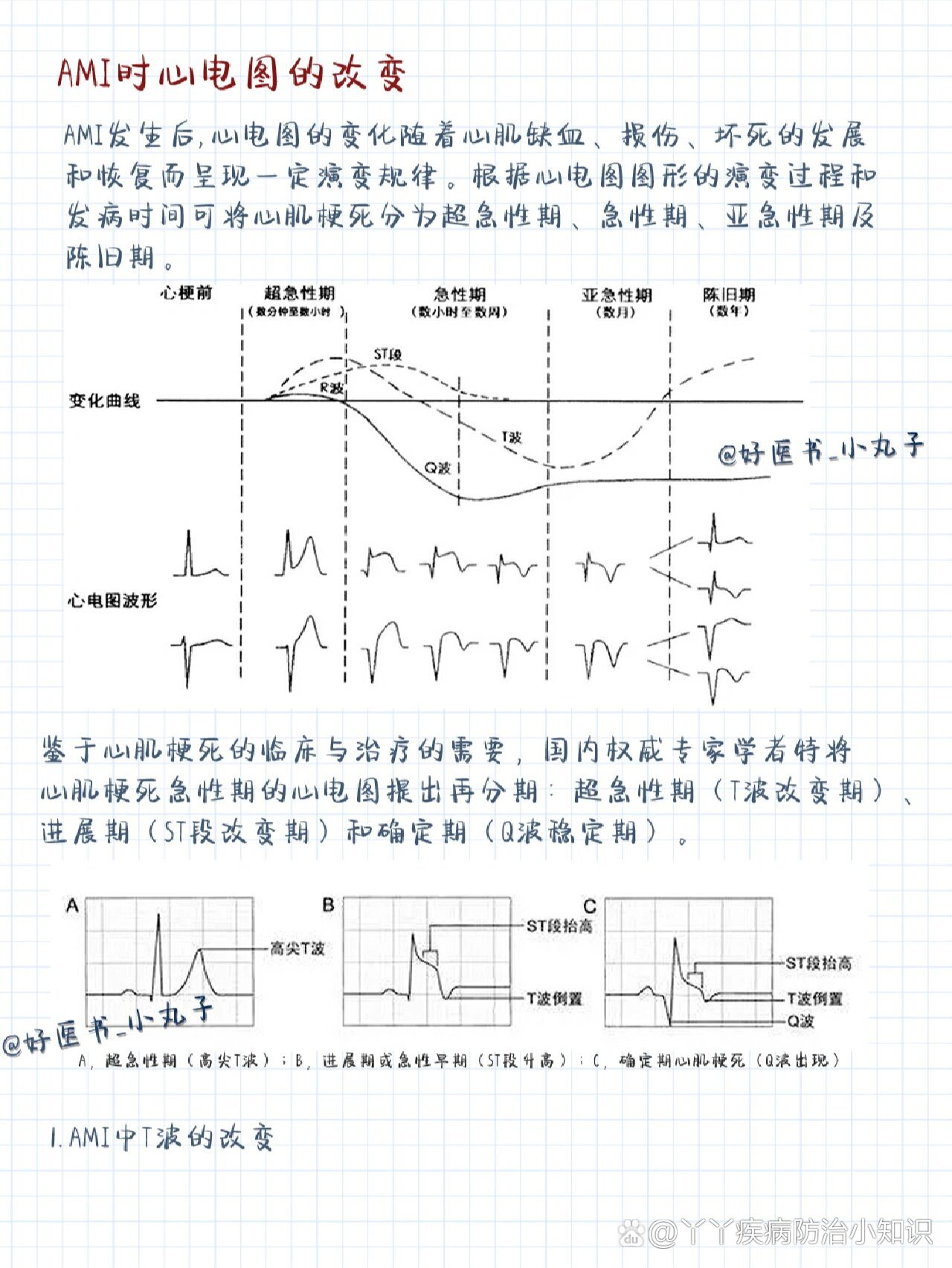 心绞痛心电图变化图片