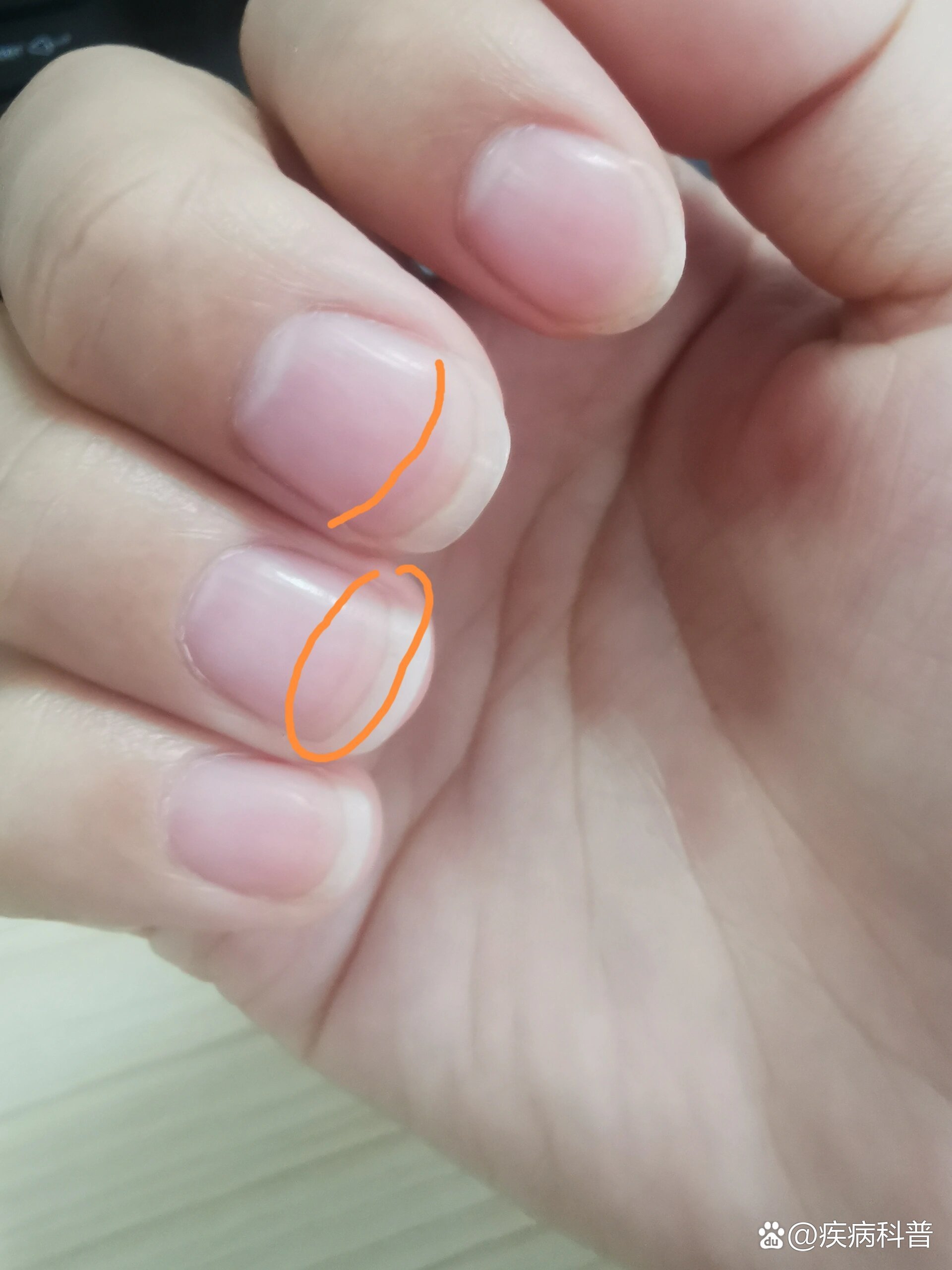 指甲盖上的白线是啥呀