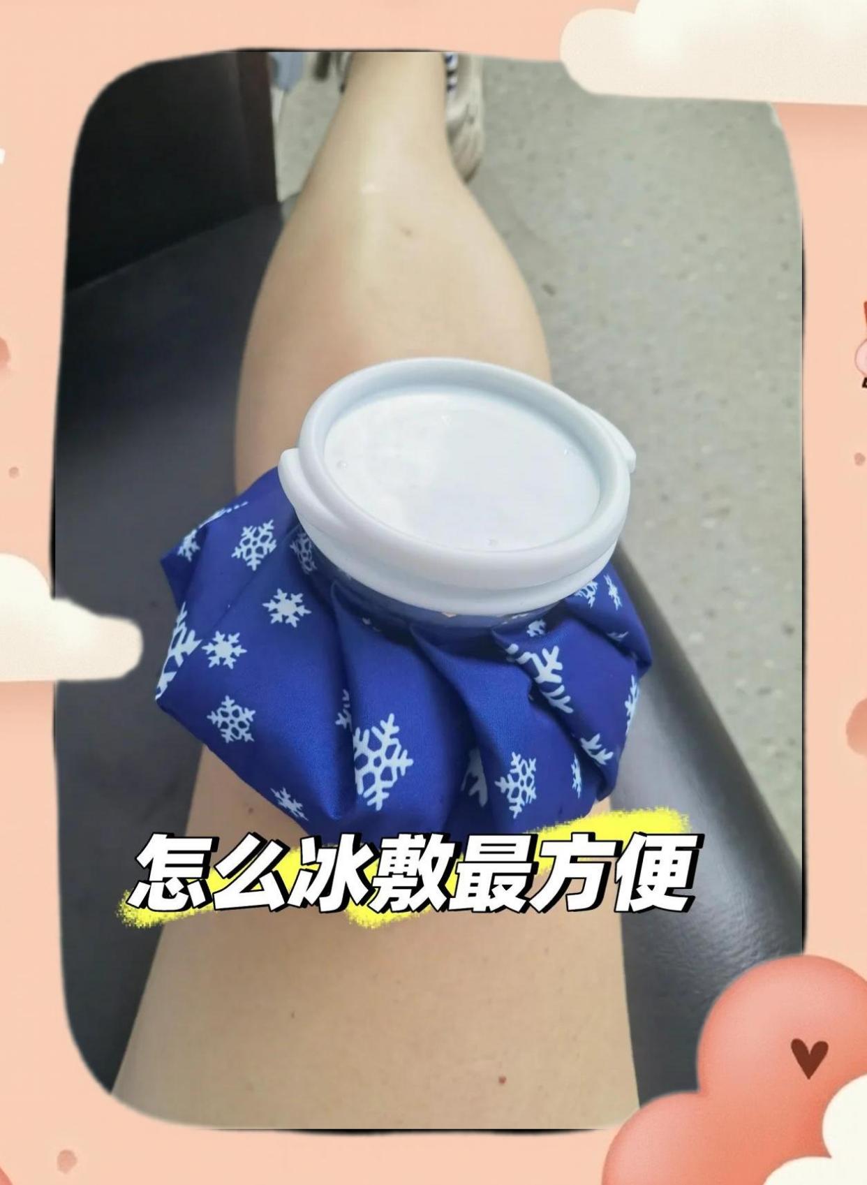 冰敷术！