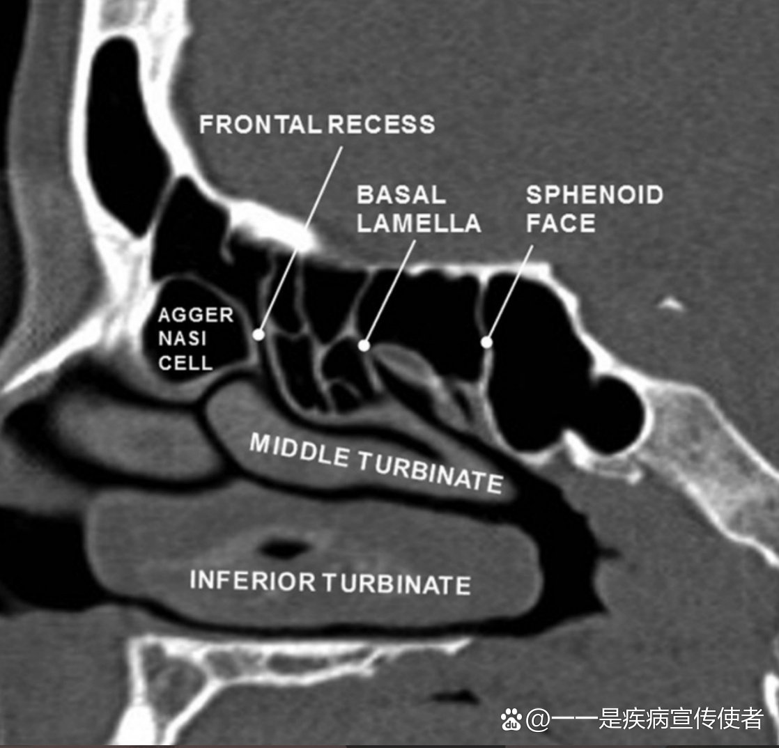 鼻窦钩突图片