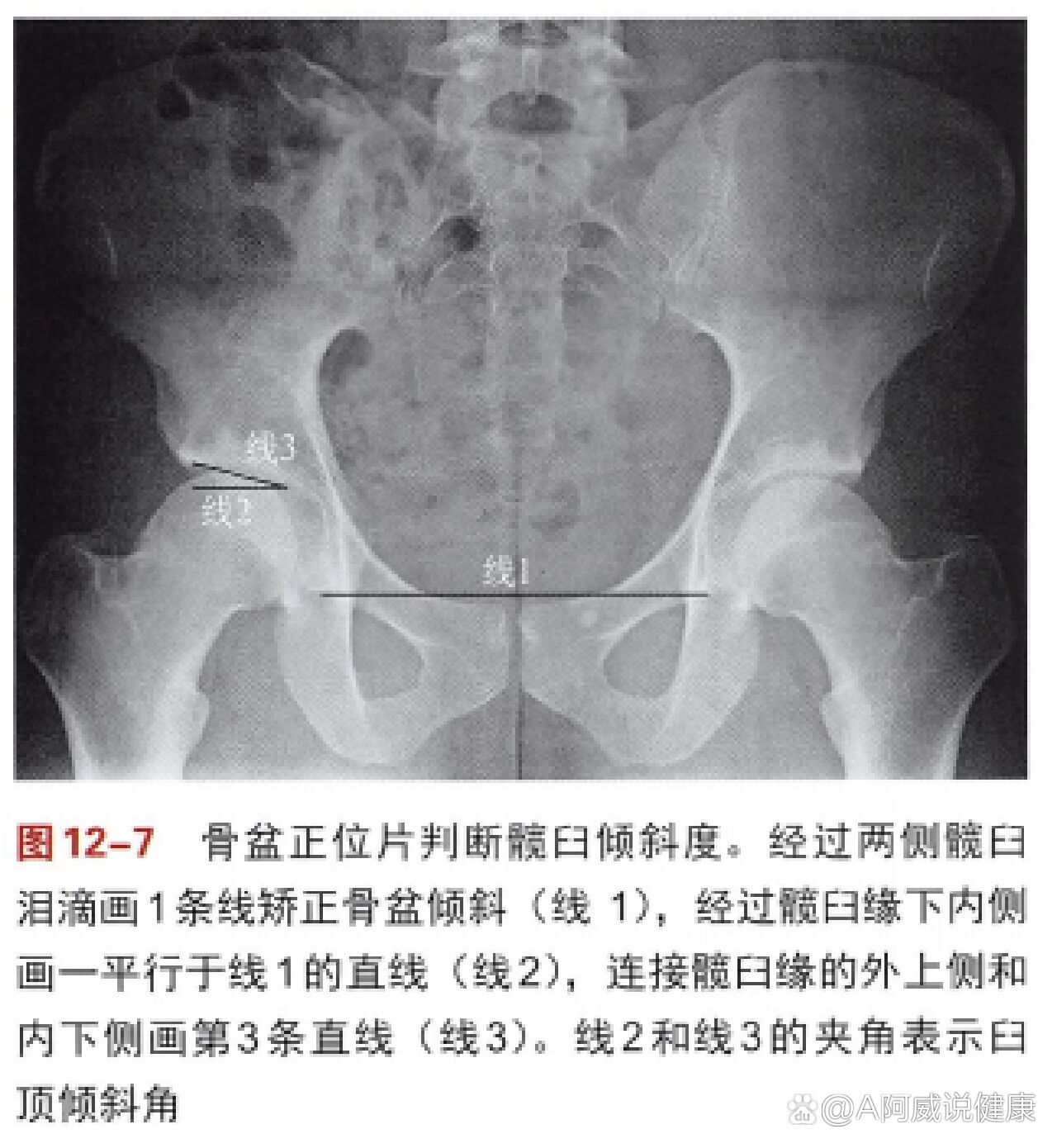 髋关节屈曲角度图片图片