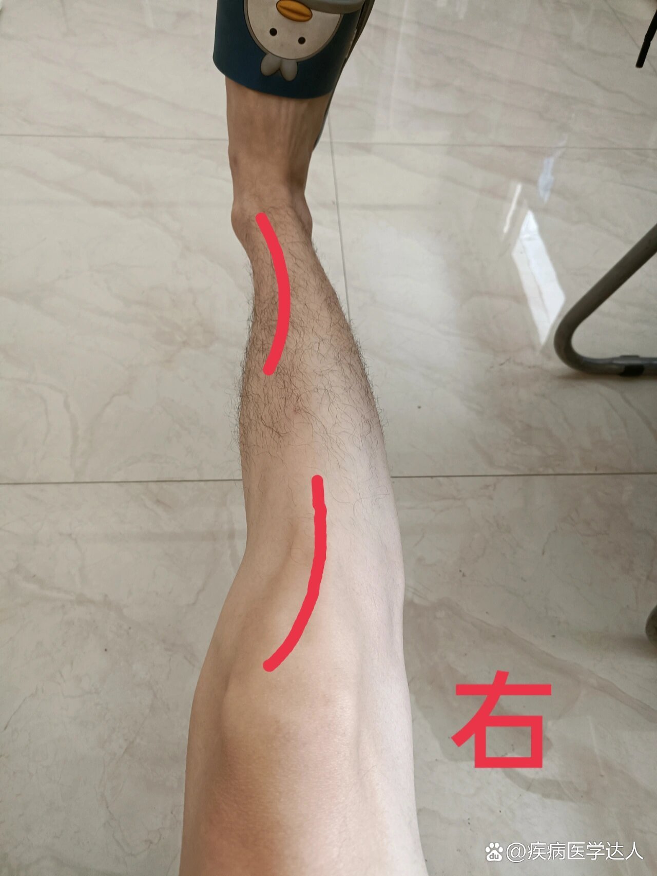 o型腿,难道是小腿骨头就是弯的吗?