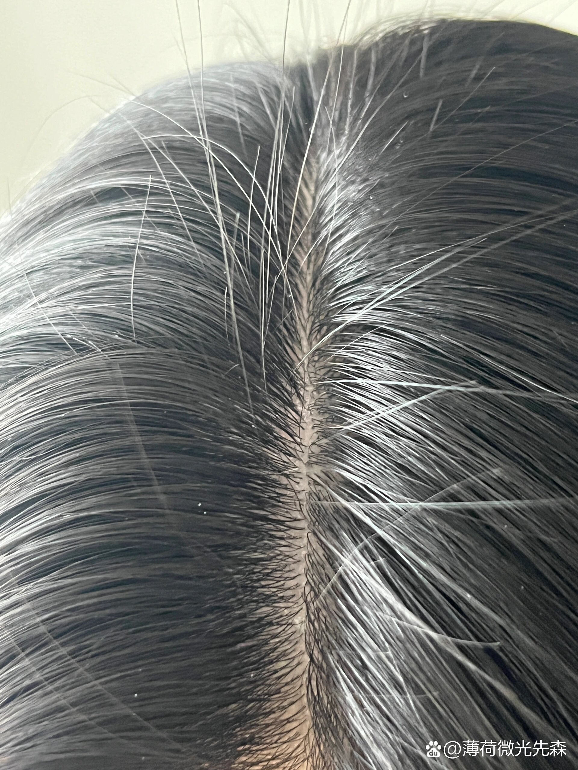 发根处白色管状物用白醋兑水洗后减少