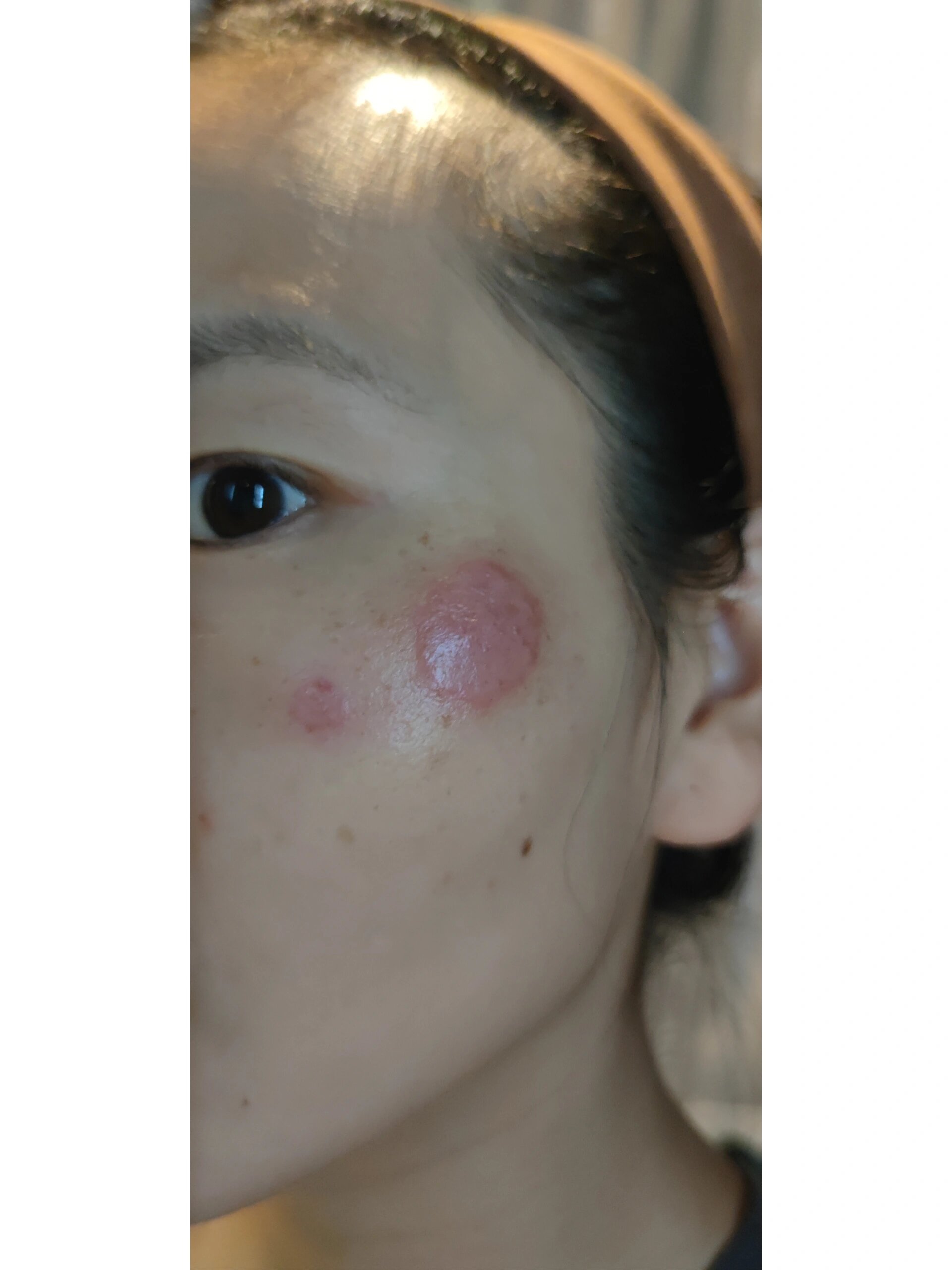 脸上长癣