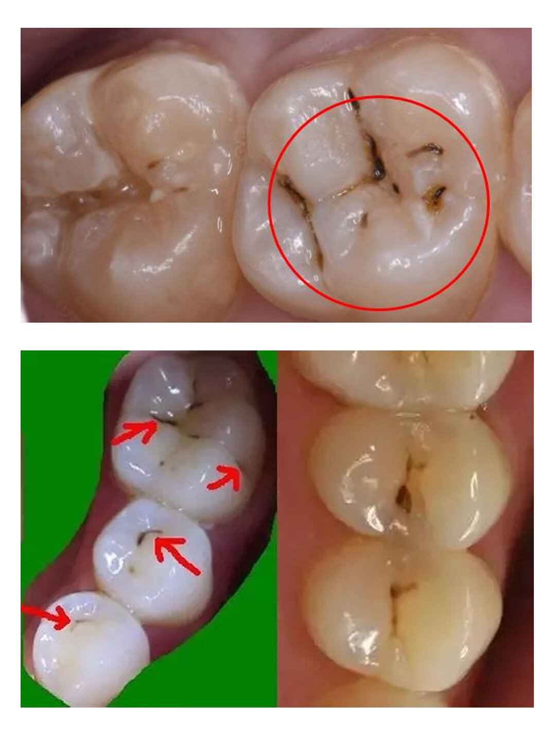 牙齿表面有小黑点图片图片