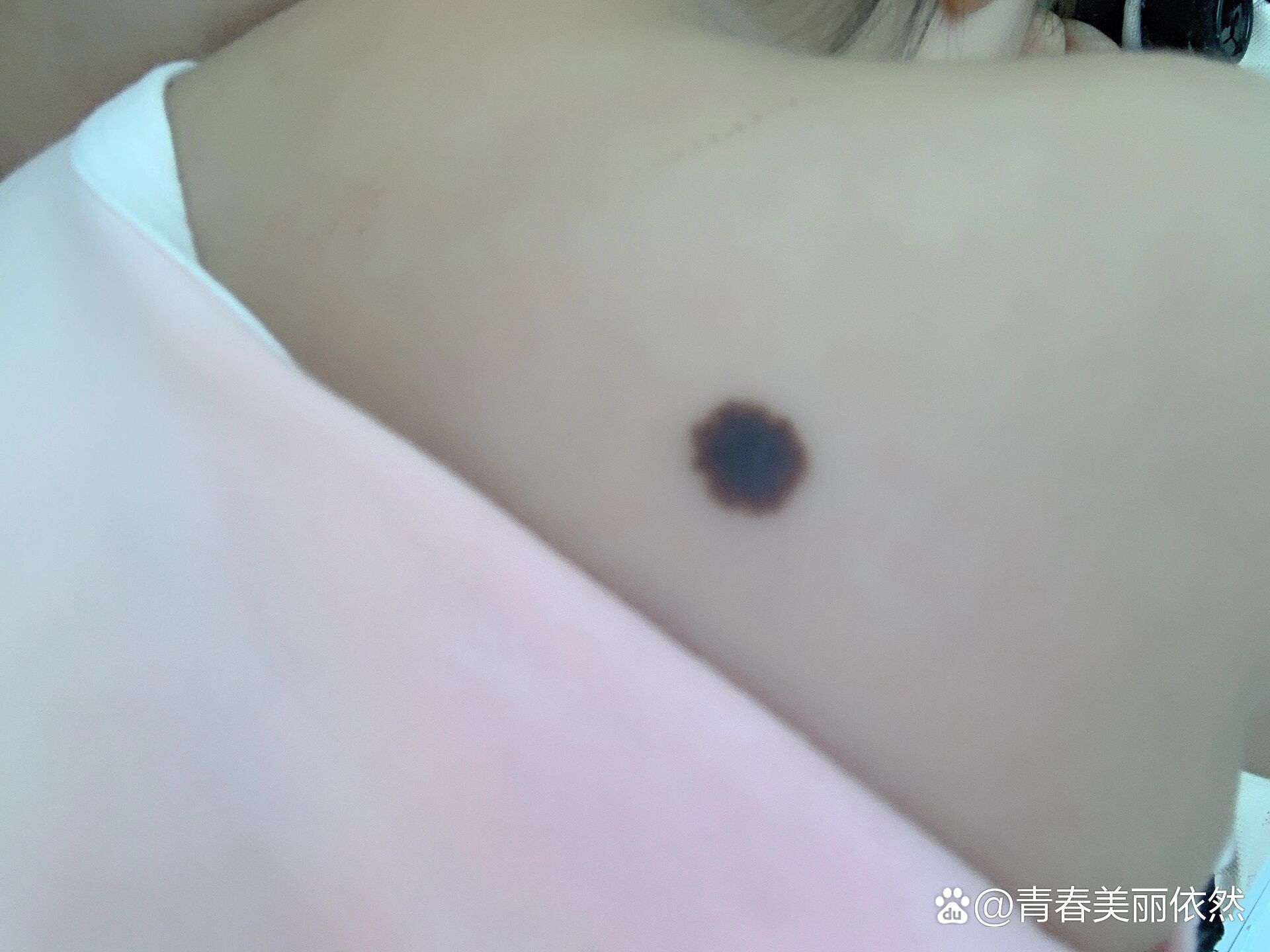 宝宝后背胎记变大了要不要去掉