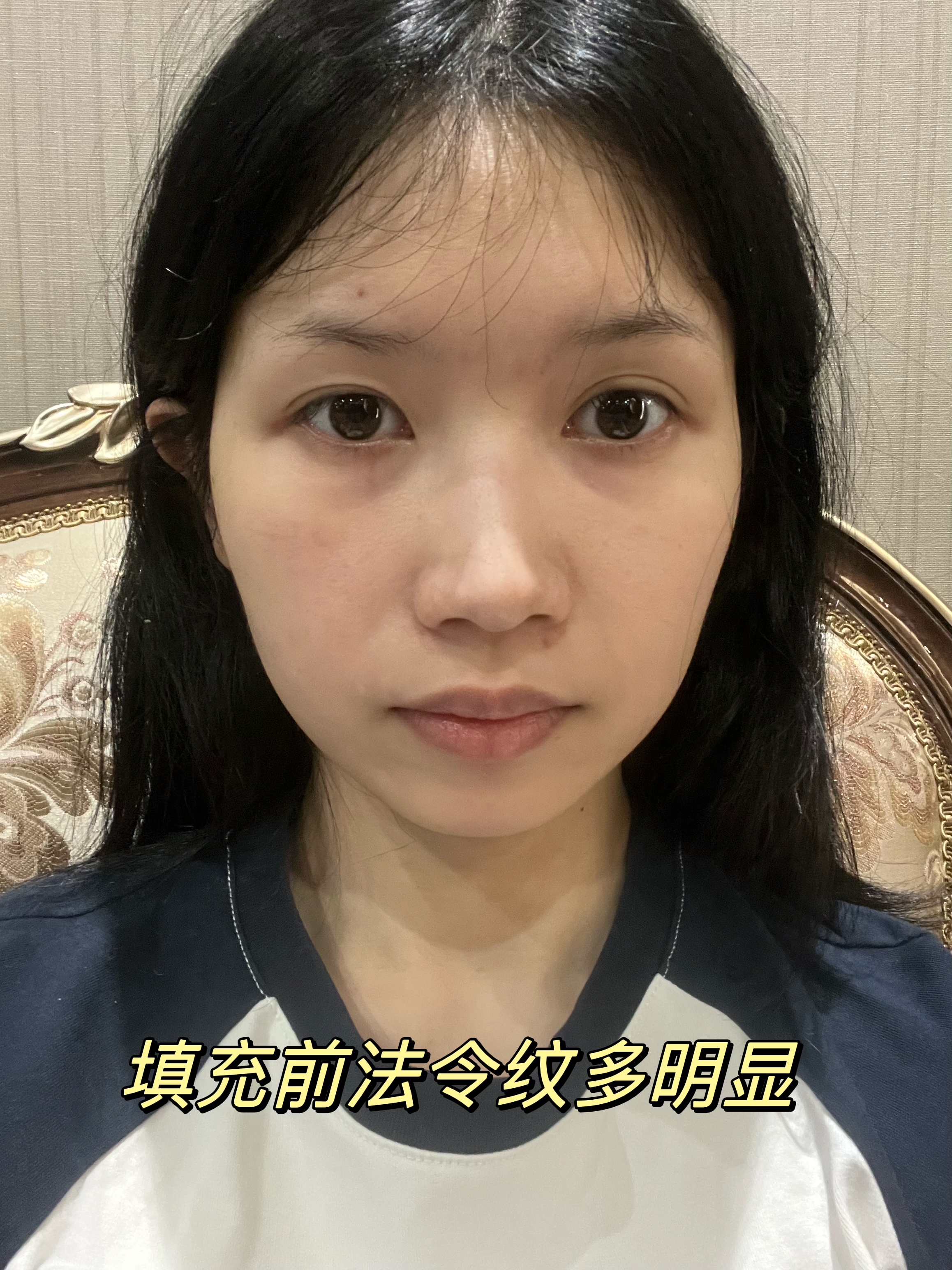 玻尿酸填充法令纹真是立竿见影