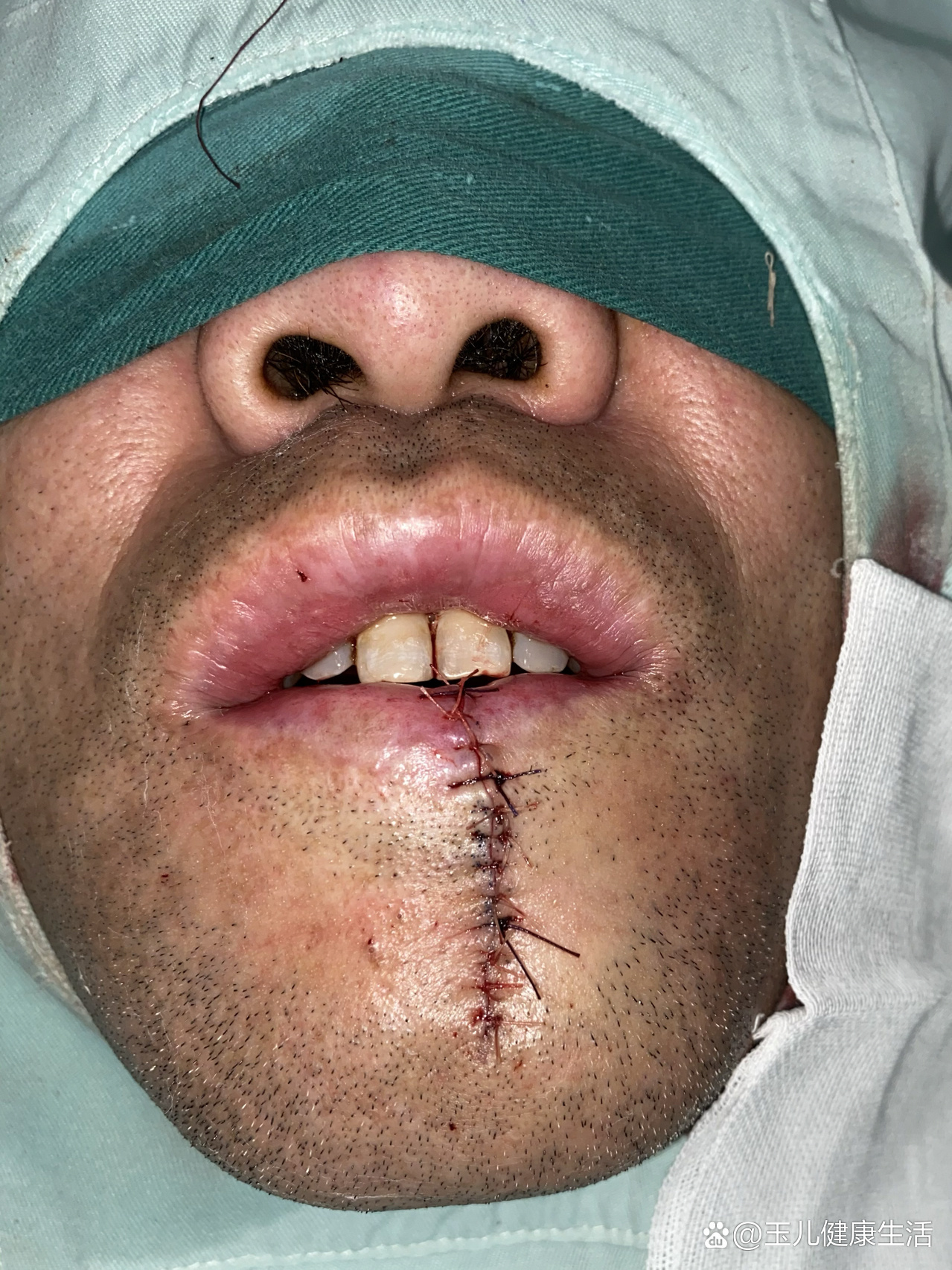 口唇恶性肿瘤,提高认识,提前预防!